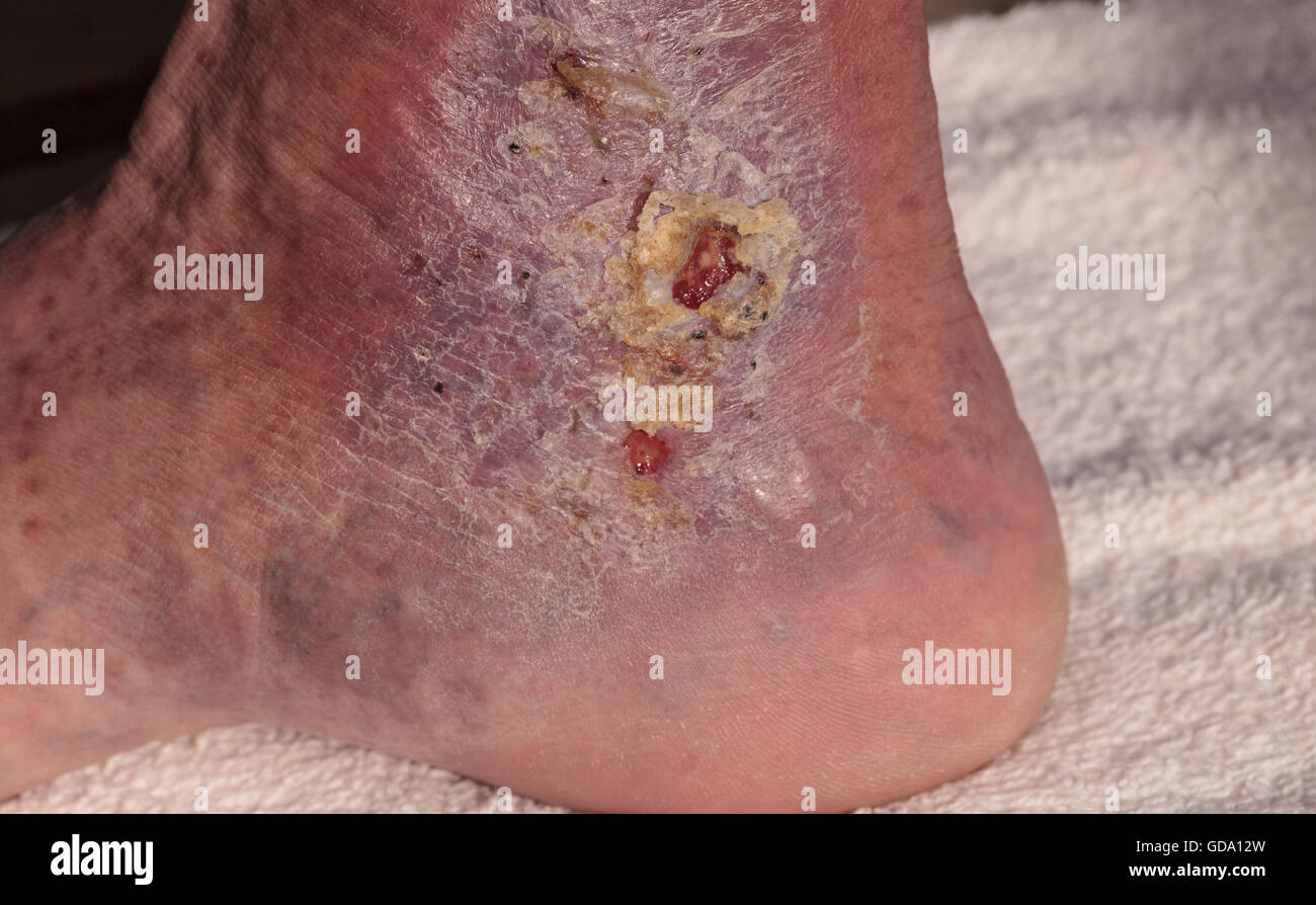 Medical Photo : Infection cellulite sur la peau d'une cheville causé par la phlébite et caillots de sang dans la veine. Banque D'Images
