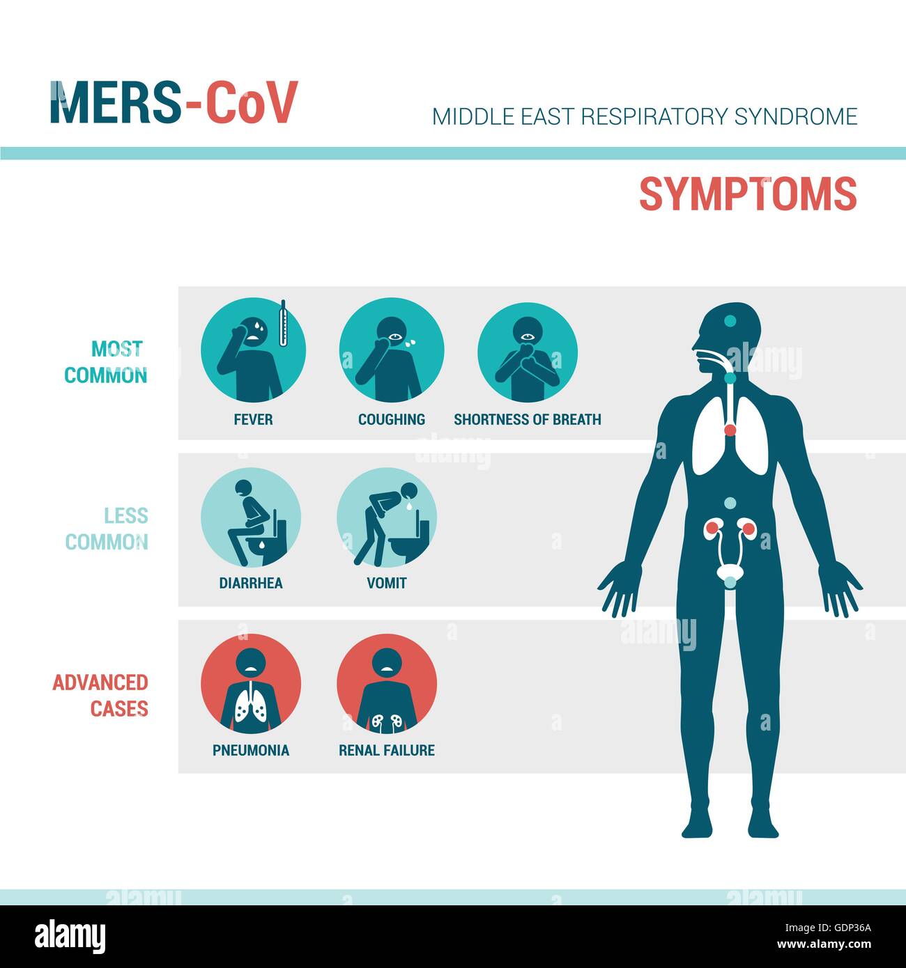 MERS CoV infographie médicale symptômes avec figures bâton et corps humain Illustration de Vecteur