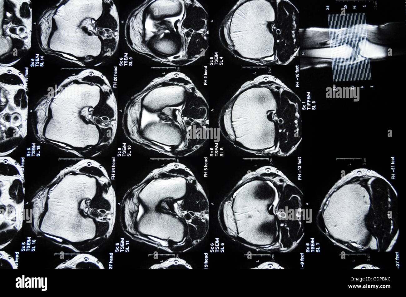 : Imagerie par résonance magnétique ( IRM ) : des images transversales d'un genou, , , Banque D'Images