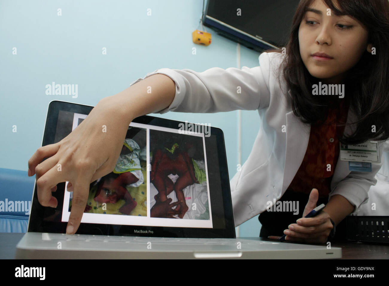 L'équipe de médecin, d'expliquer le plan de séparation des frères siamois de chirurgie (omphalopagus deux bébés fusionné à l'abdomen), bébé Safira et Saqira (4 mois) une heure plus tôt avant de subir l'opération à Cipto Mangunkusumo Hôpital Central National. Le plan, l'opération débutera à 8h00 avec une estimation de prendre 4 heures et a réuni 40 spécialistes tels que spécialiste chirurgie pédiatrique, la chirurgie plastique, anesthésie, radiologie, réadaptation médicale, la pathologie clinique, psychiatrie, pharmaciens, et autres. Safira et Saqira sont la 23e jumeaux siamois qui feront l'objet d'une opération de séparation par Banque D'Images