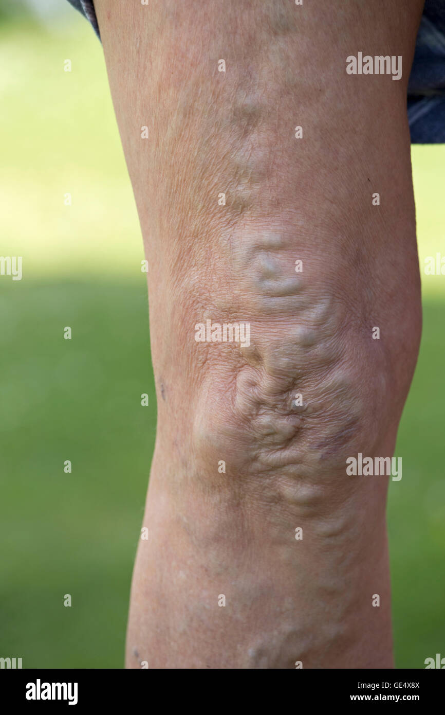 Swollend varices veines élargie et la peau déformée dans les genoux et les jambes d'une femme âgée uk Banque D'Images