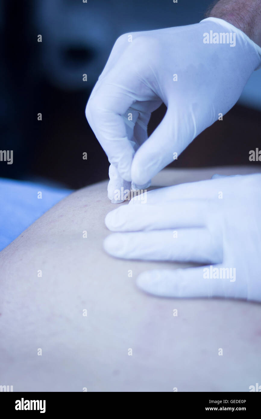 Aiguille sèche acupunture thérapie avec acupunturist physiothérapeute en clinique de l'hôpital. Banque D'Images