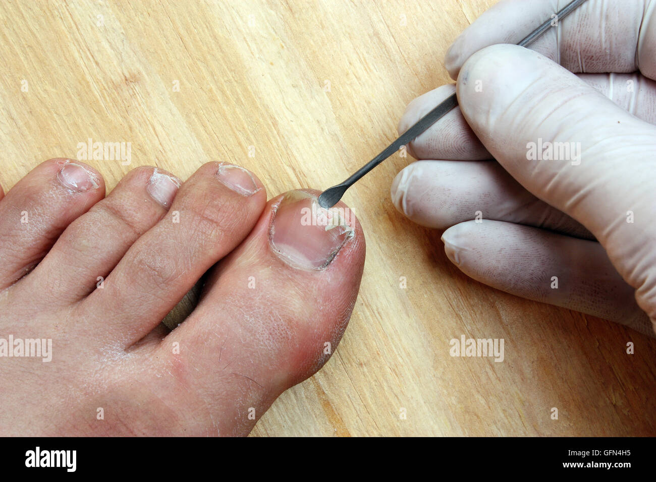Le traitement par un médecin chirurgien rompu à l'ongle d'orteil Banque D'Images