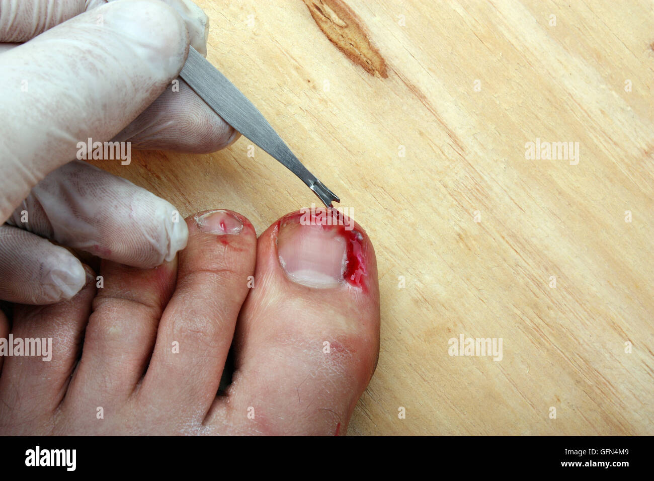 Chirurgie sur un ongle d'orteil cassé purge un homme Banque D'Images
