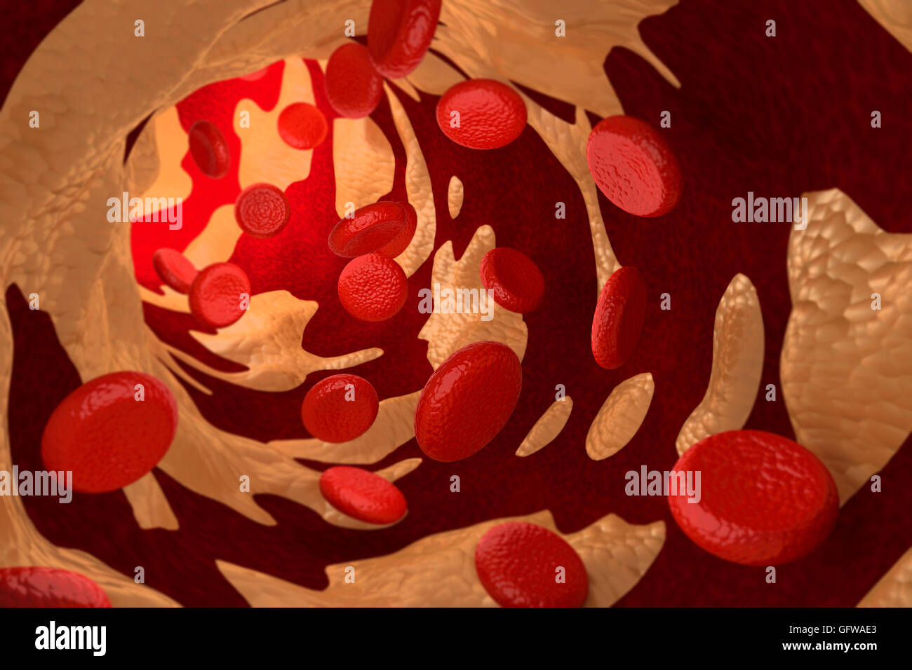 Le rendu 3D de l'artériosclérose par plaque de cholestérol Photo Stock Alamy