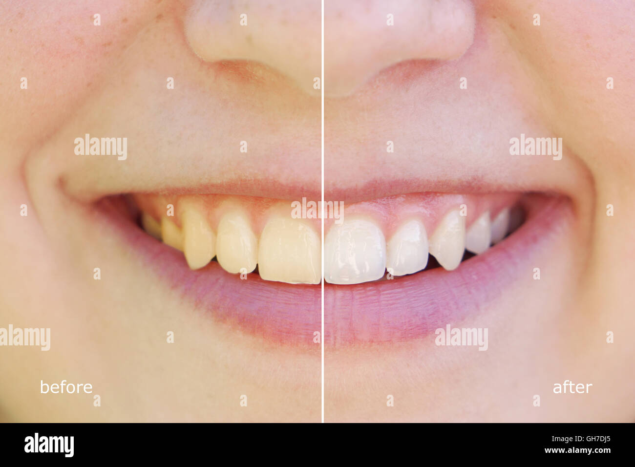 Avant et après le blanchiment des dents Banque D'Images