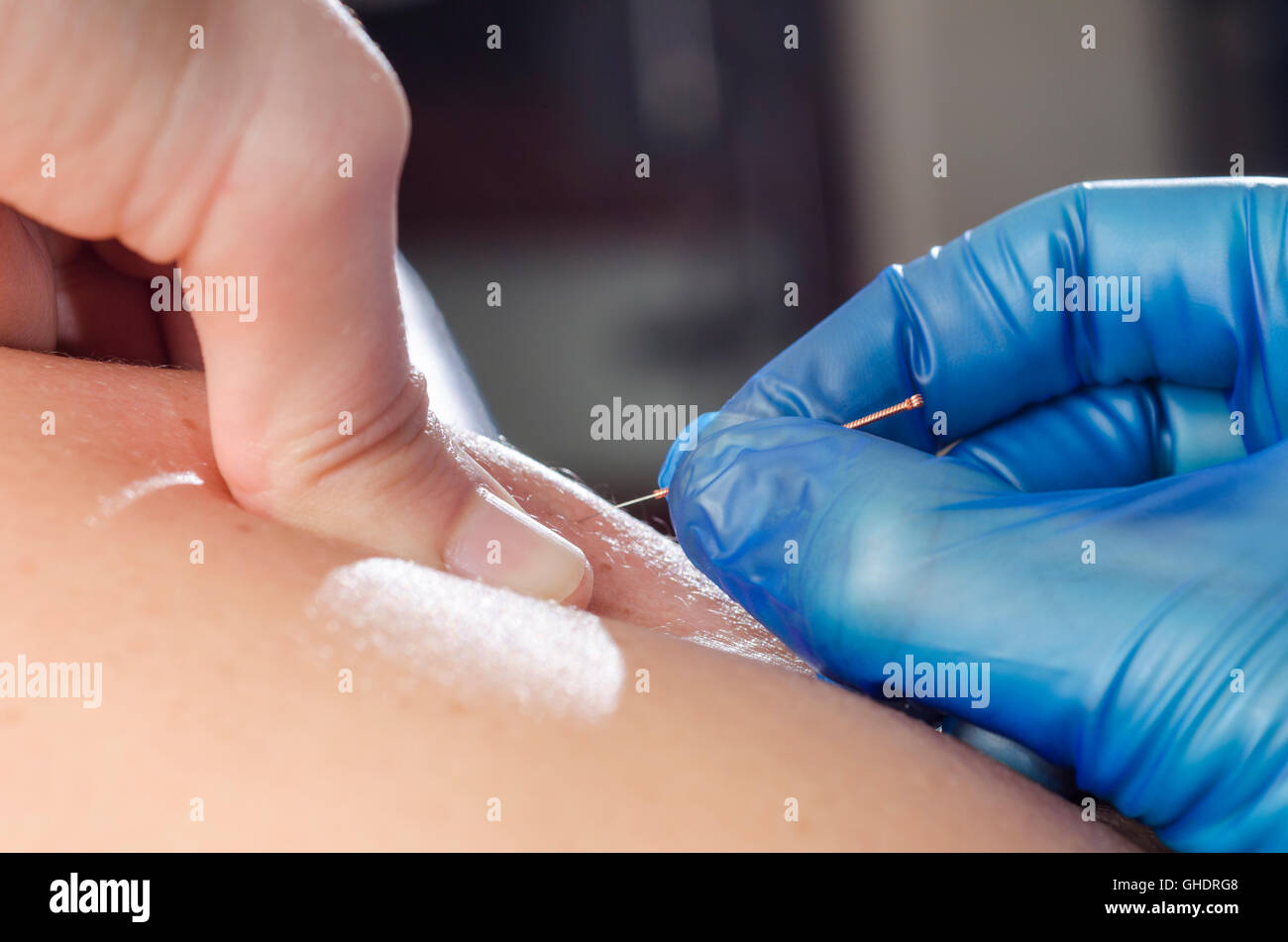 Libre d'une aiguille et les mains de kinésithérapeute faisant une aiguille sèche. Banque D'Images