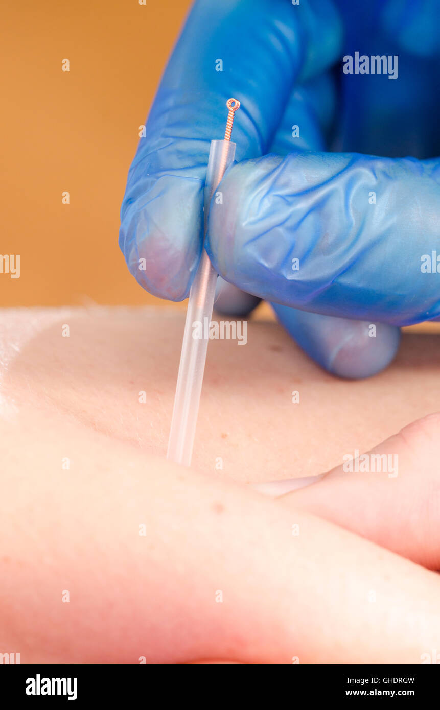 Libre d'une aiguille et les mains de kinésithérapeute faisant une aiguille sèche. Banque D'Images