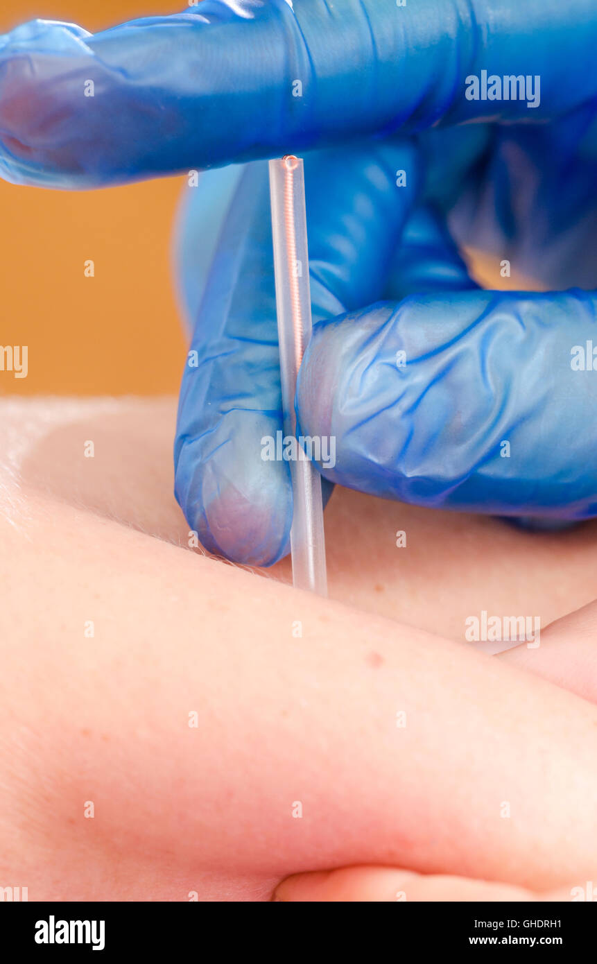 Libre d'une aiguille et les mains de kinésithérapeute faisant une aiguille sèche. Banque D'Images