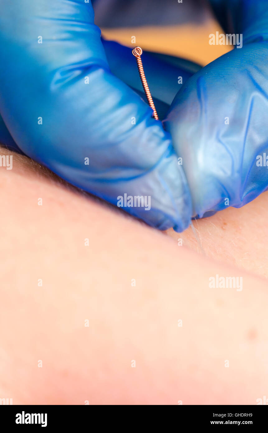 Libre d'une aiguille et les mains de kinésithérapeute faisant une aiguille sèche. Banque D'Images