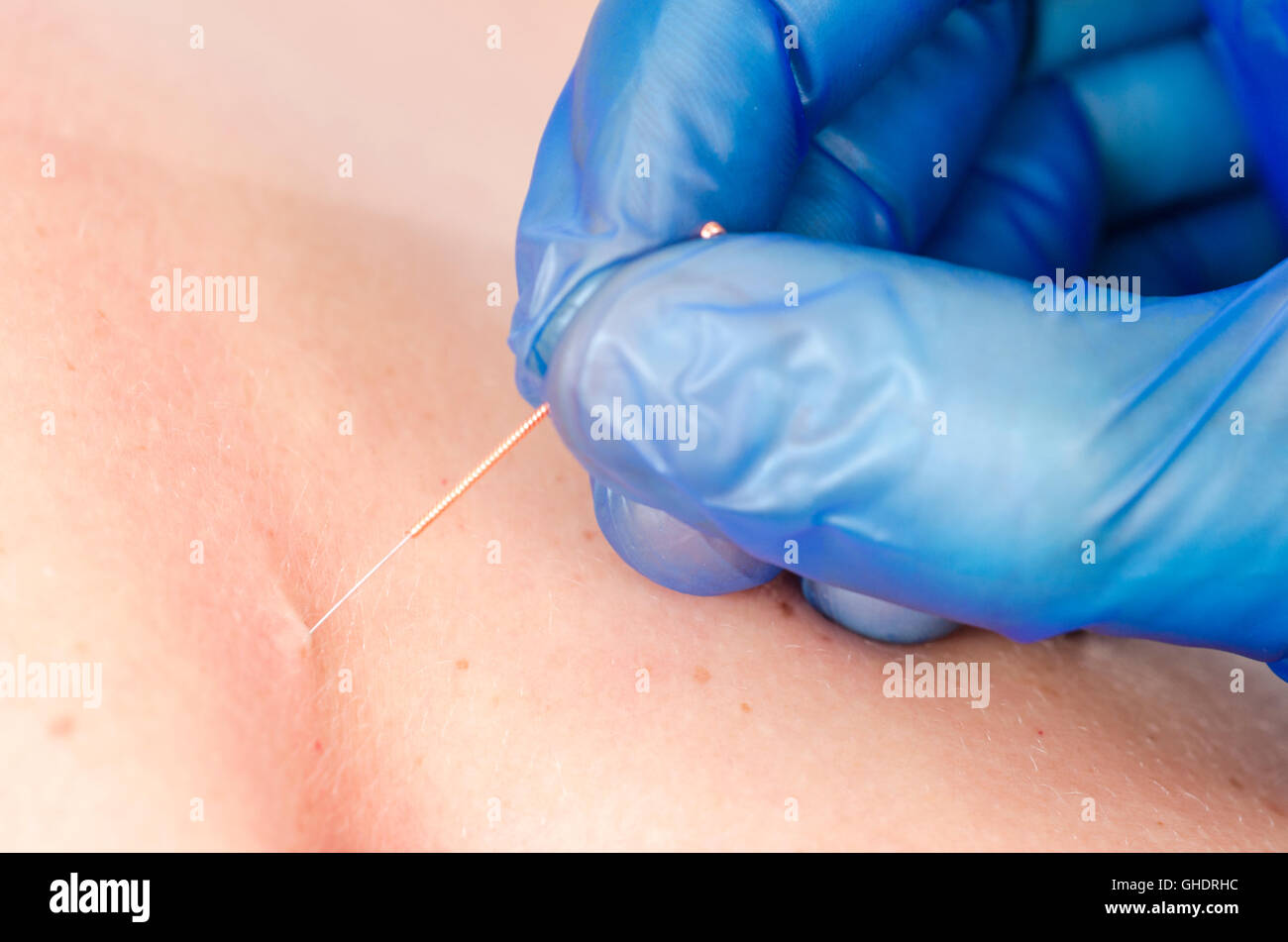 Libre d'une aiguille et les mains de kinésithérapeute faisant une aiguille sèche. Banque D'Images