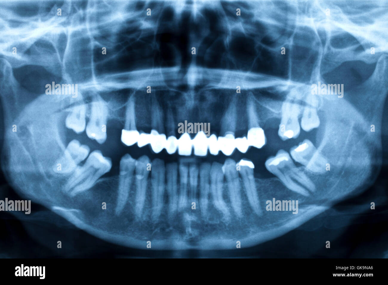 Mâchoire inférieure de un adulte avec de mauvaises dents dans la radiographie Banque D'Images