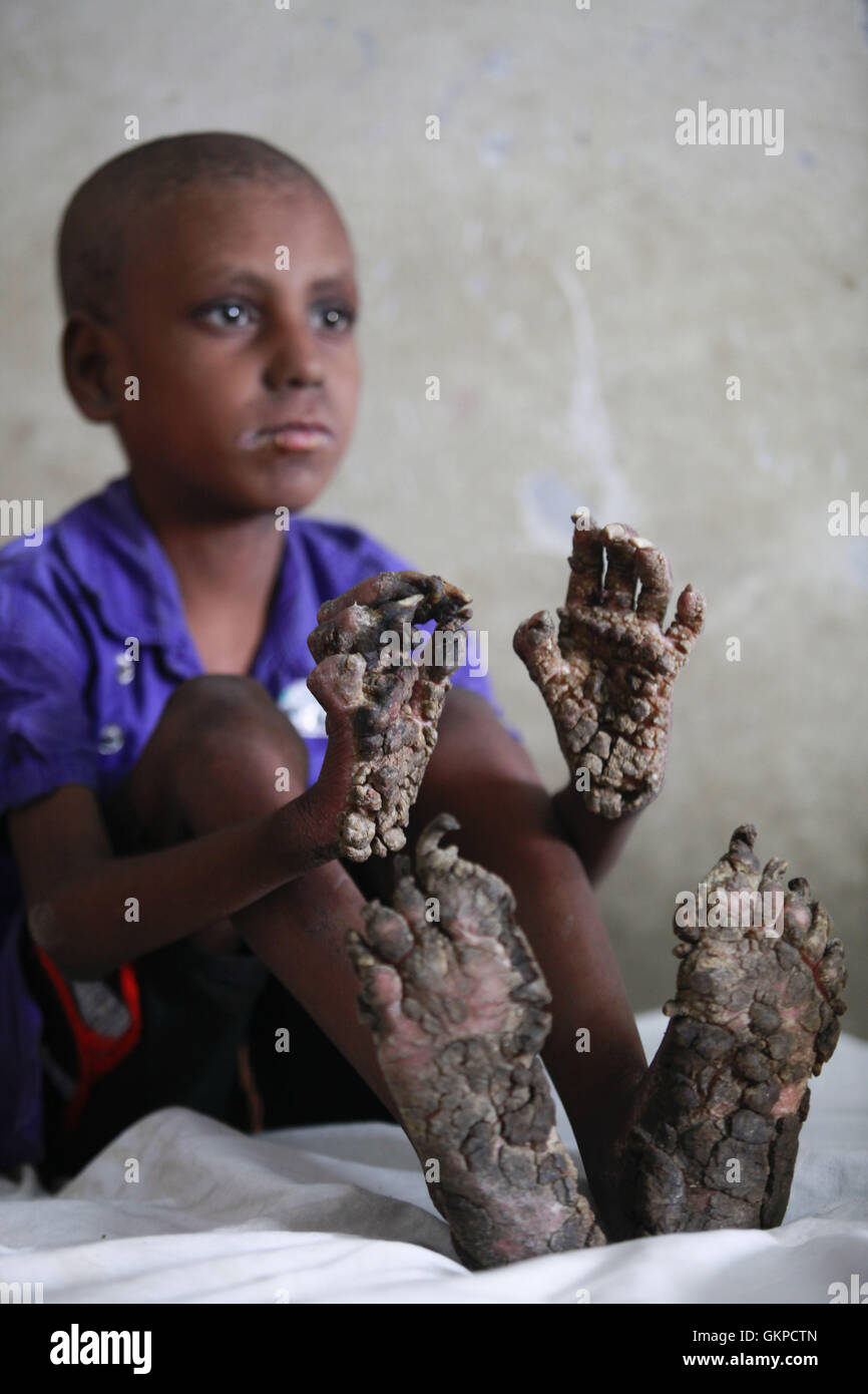 Dhaka, Bangladesh. Août 22, 2016. RIPON ROY, 7, de Thakurgaon district, l'hôpital se trouve sur un mauvais. Ripon a été souffrant de la maladie de l'homme arbre, un trouble rare de la peau causée par un virus appelé virus du papillome humain. Ripon est un élève de classe II Gouvernement Ketgaon l'école primaire, a été touché alors qu'il n'avait que trois mois, a déclaré Mohendra Roy, son père. Verrues ont commencé à se développer sur sa paume et pied, qui sont plus gros, il a dit, tout en cherchant de l'aide pour son fils un meilleur traitement. © Suvra Kanti Das/ZUMA/Alamy Fil Live News Banque D'Images