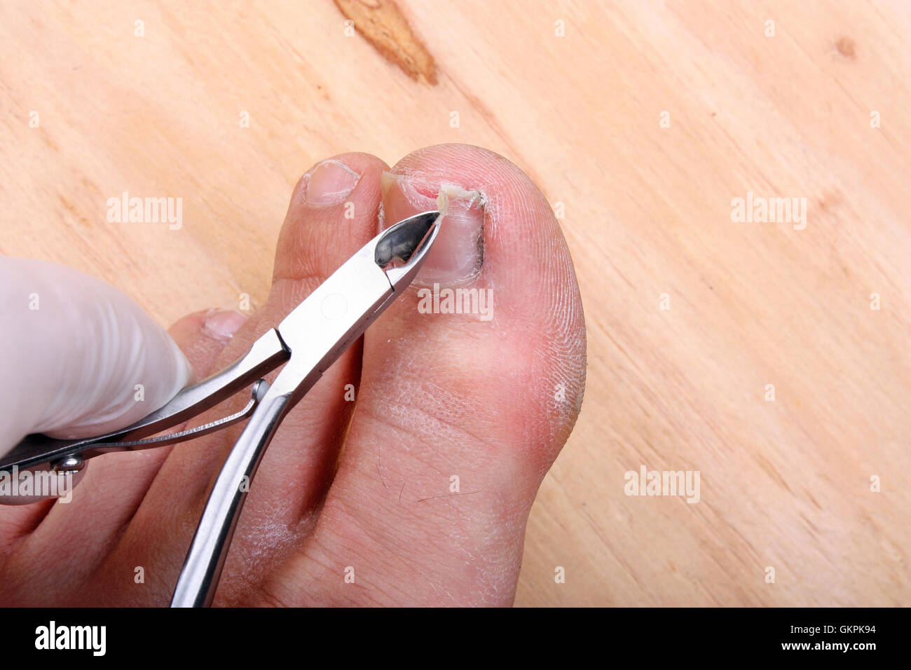 Chirurgie sur un ongle d'orteil cassé un homme Banque D'Images