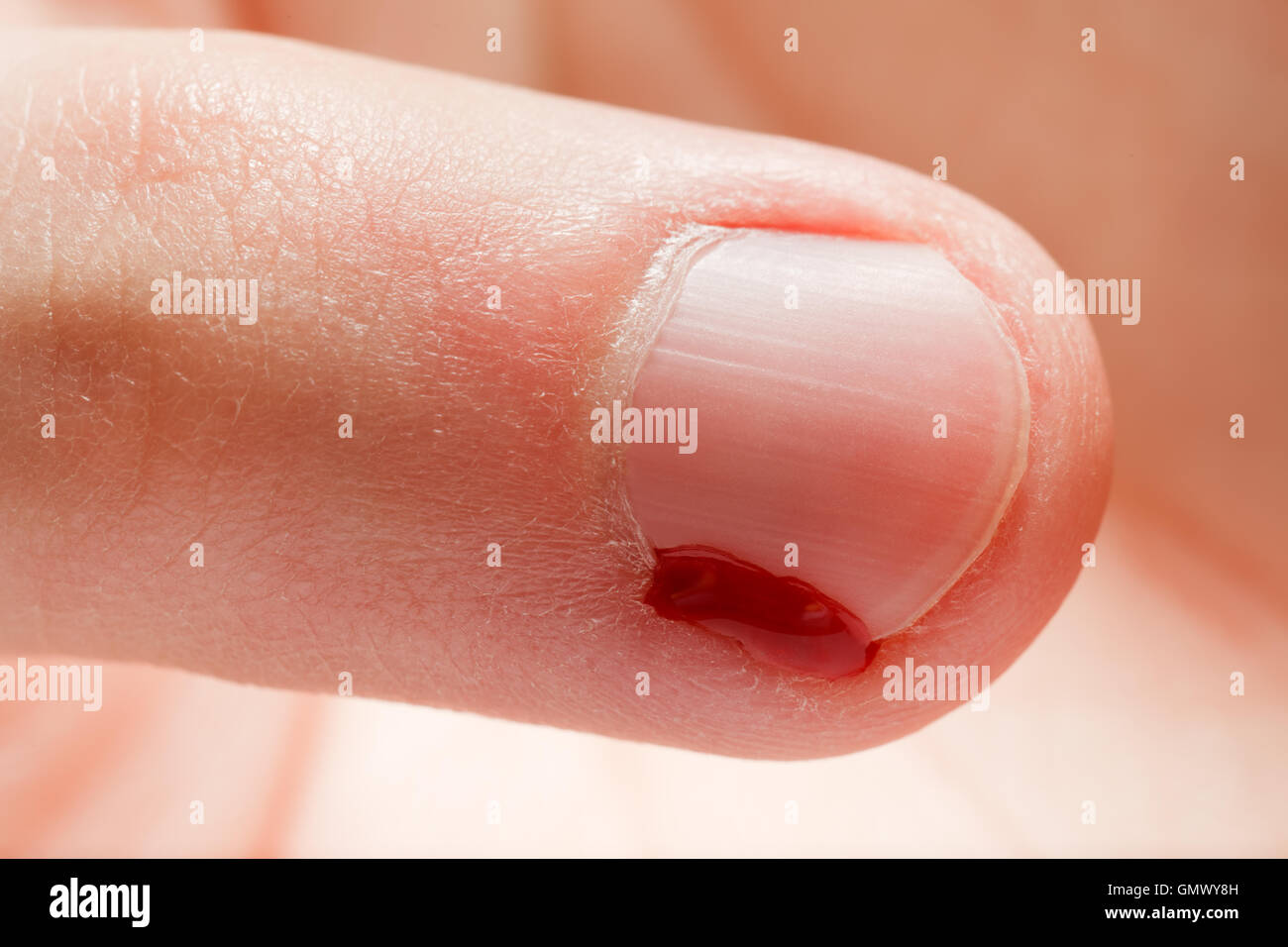 Ongle de la plaie du sang Banque D'Images