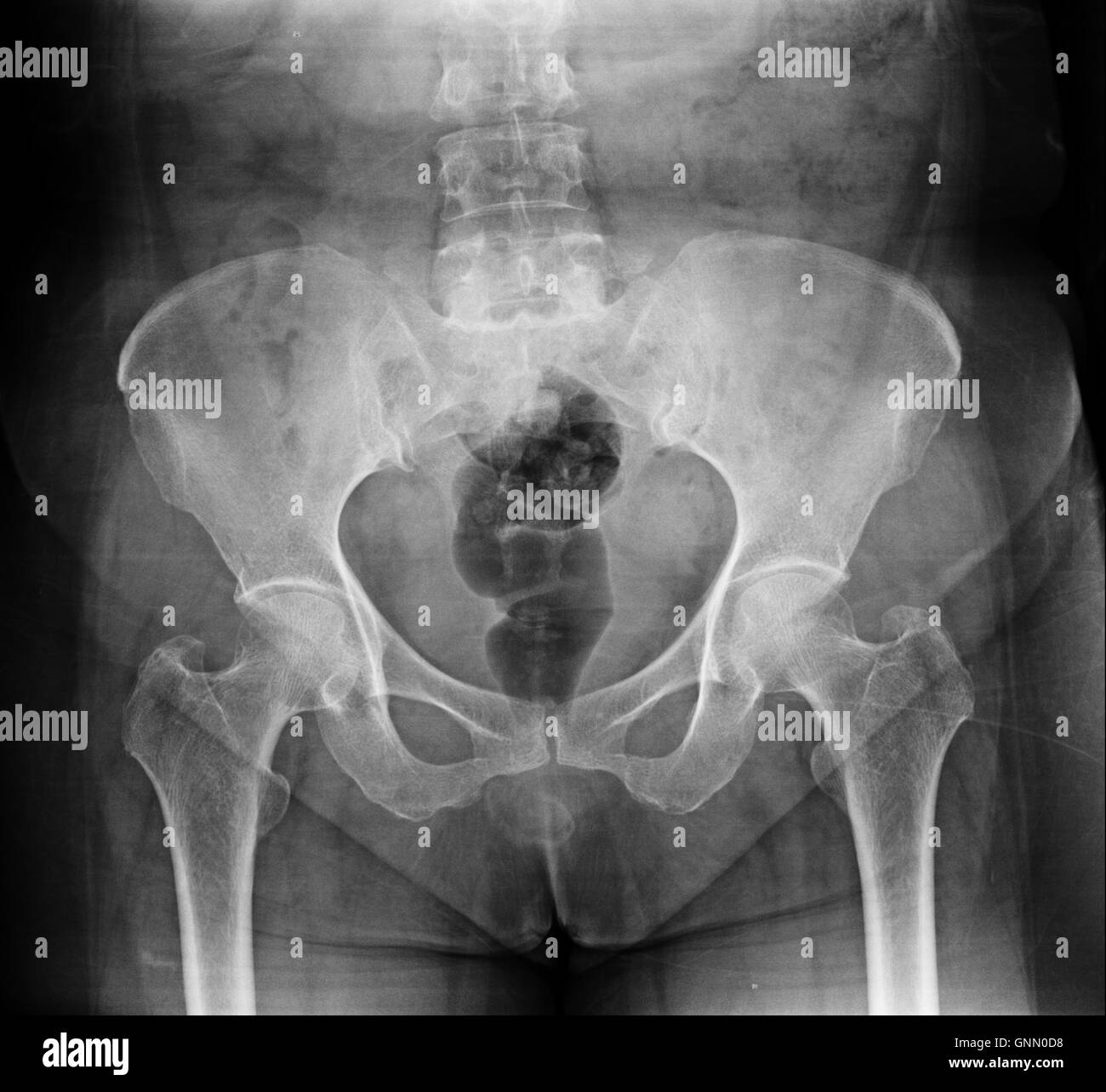 X-ray du bassin et de la colonne vertébrale. Banque D'Images