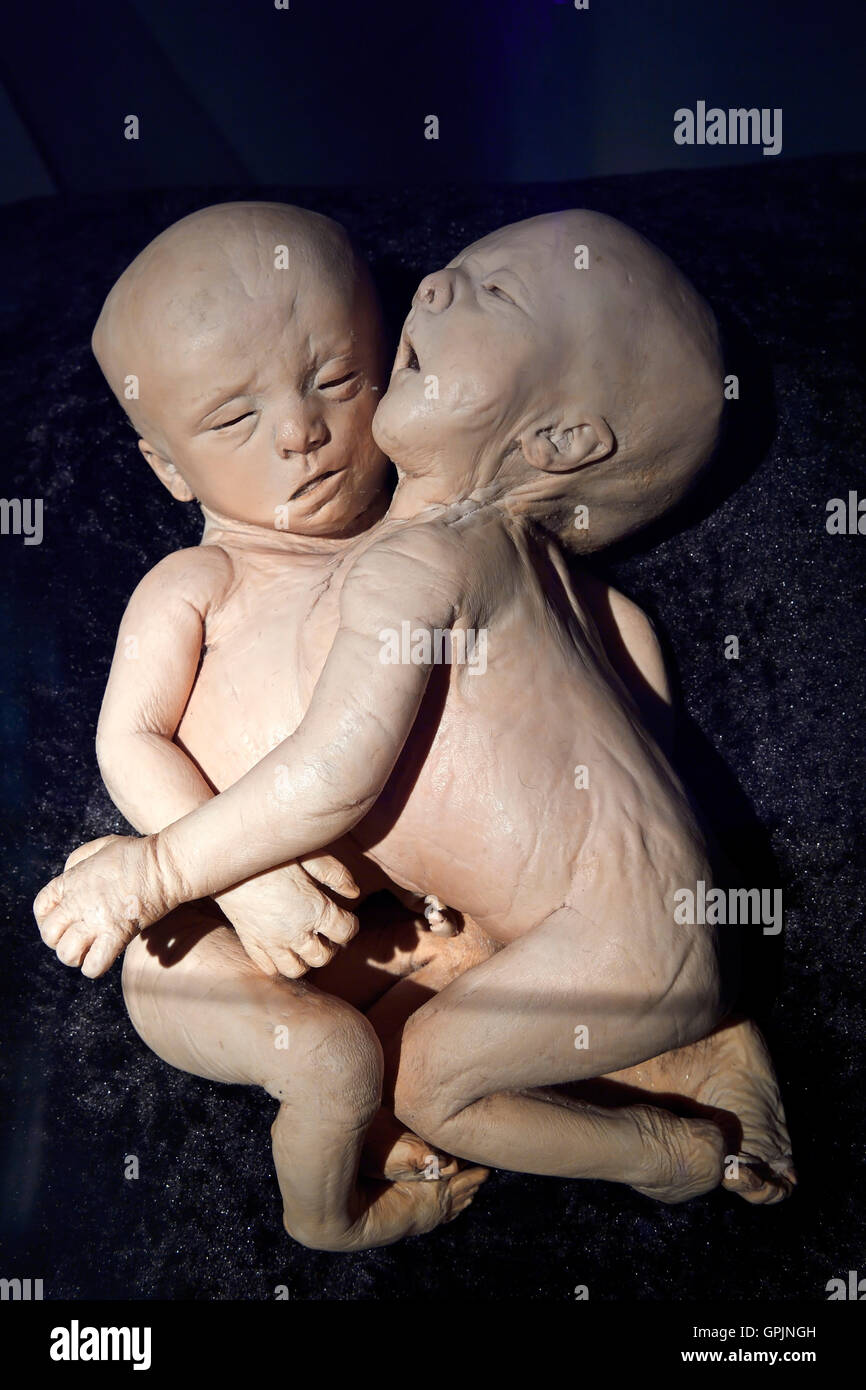 Plastinate, jumeaux siamois, le monde du corps, Menschen Museum, Berlin, Allemagne Banque D'Images