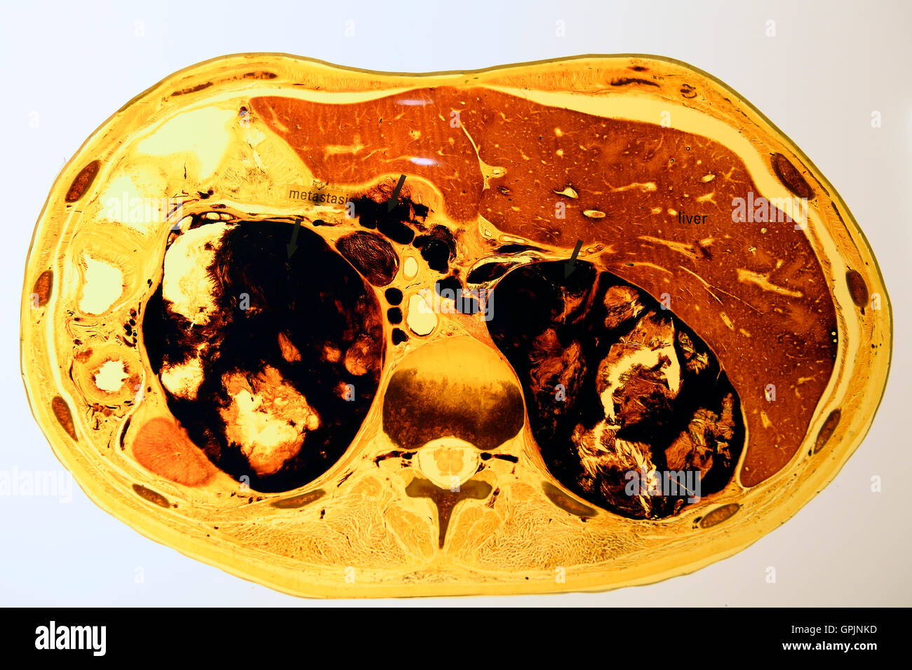 Plastinate, la section des droits de l'abdomen avec métastases du cancer de la peau, le monde du corps, Menschen Museum, Berlin, Allemagne Banque D'Images