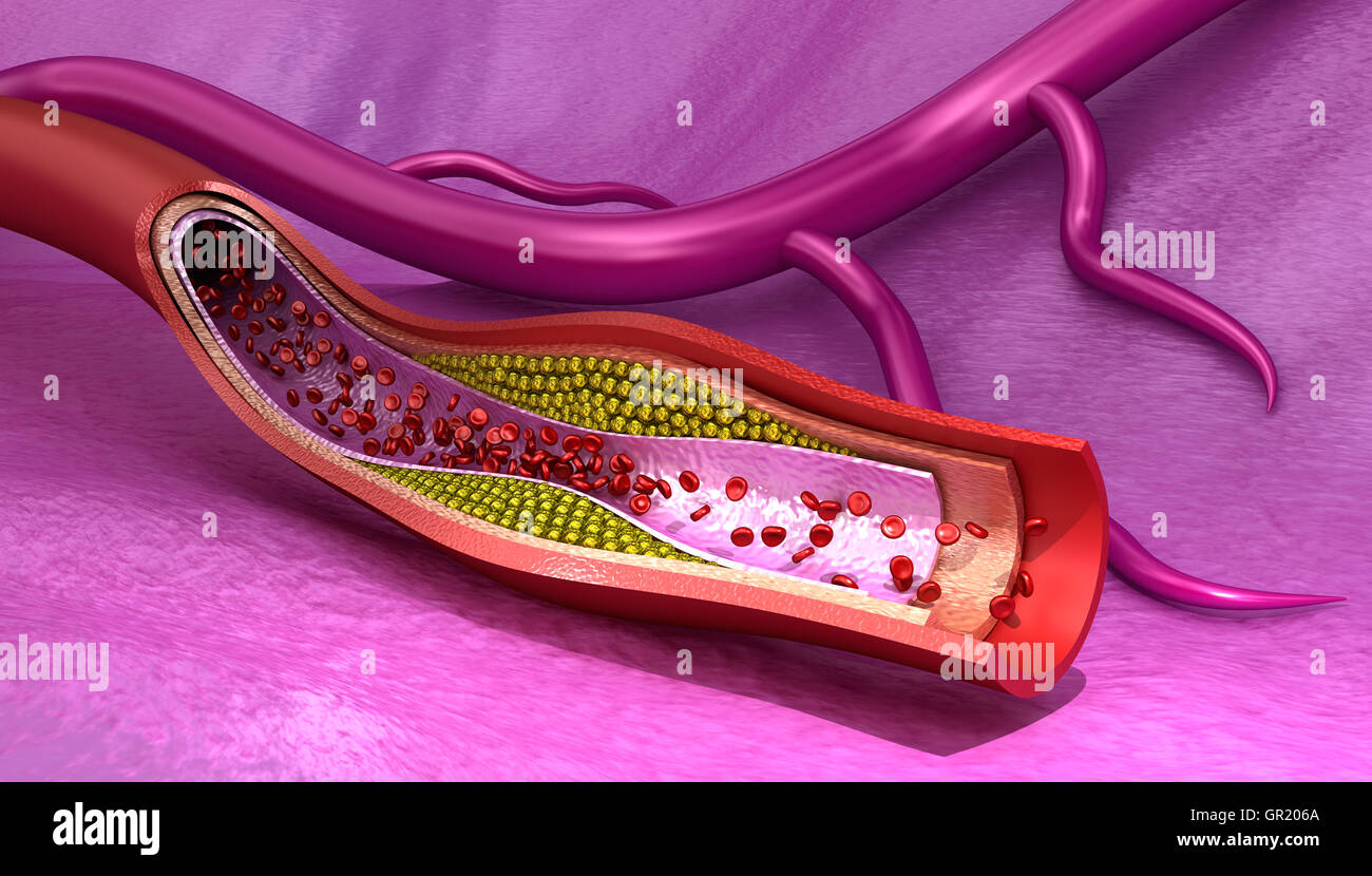 Plaque de cholestérol dans le sang , navire précis médicalement 3D illustration Banque D'Images