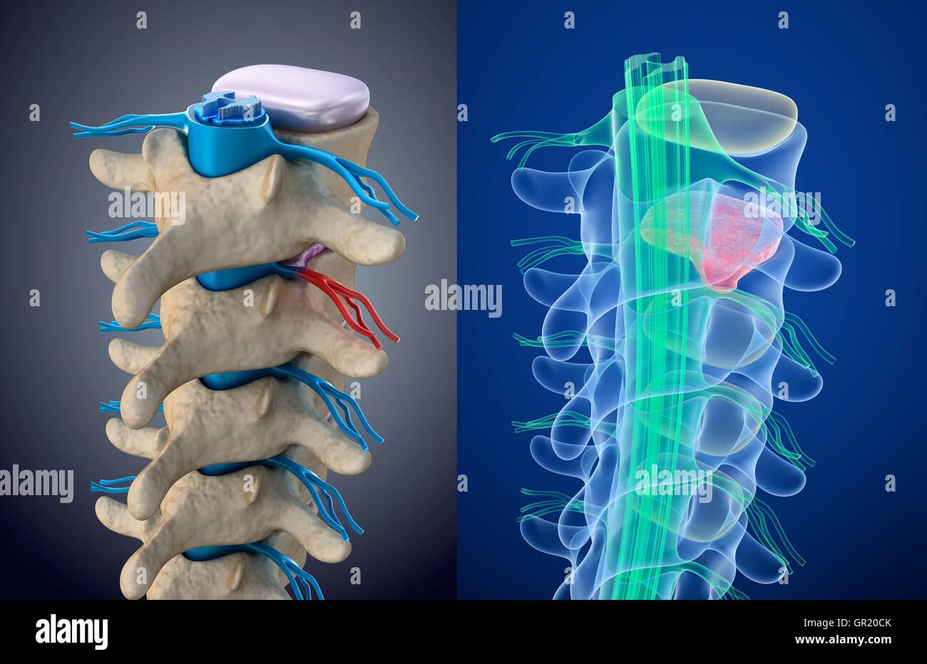 La moelle épinière sous pression de gonflement du disque. Xray vue. Illustration 3D précis médicalement Banque D'Images