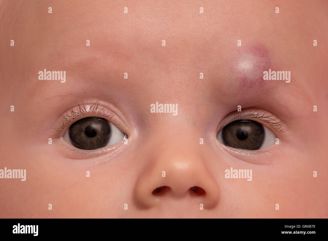 Hémangiome infantile sur le front de petite fille, le traitement par propranol. Banque D'Images