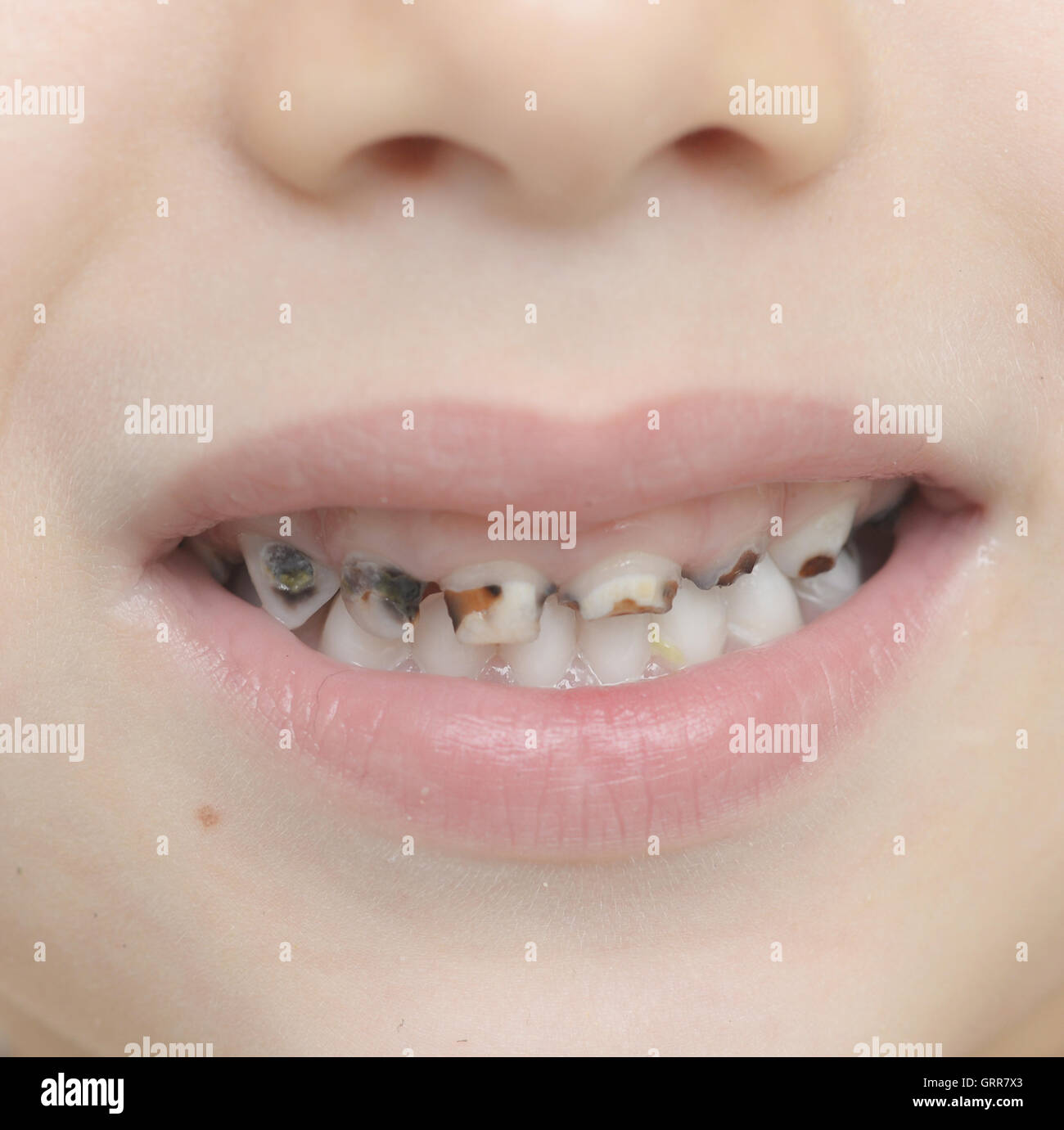 Rapprochee Sur Les Dents De Bebe Avec La Carie Dentaire Photo Stock Alamy