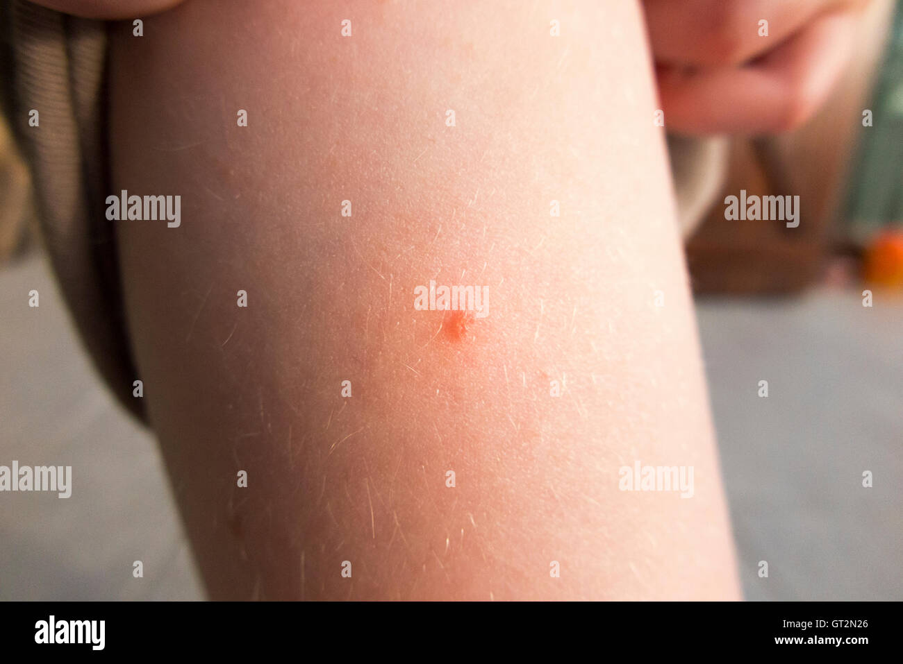 Trichobilharzia Banque D Image Et Photos Alamy