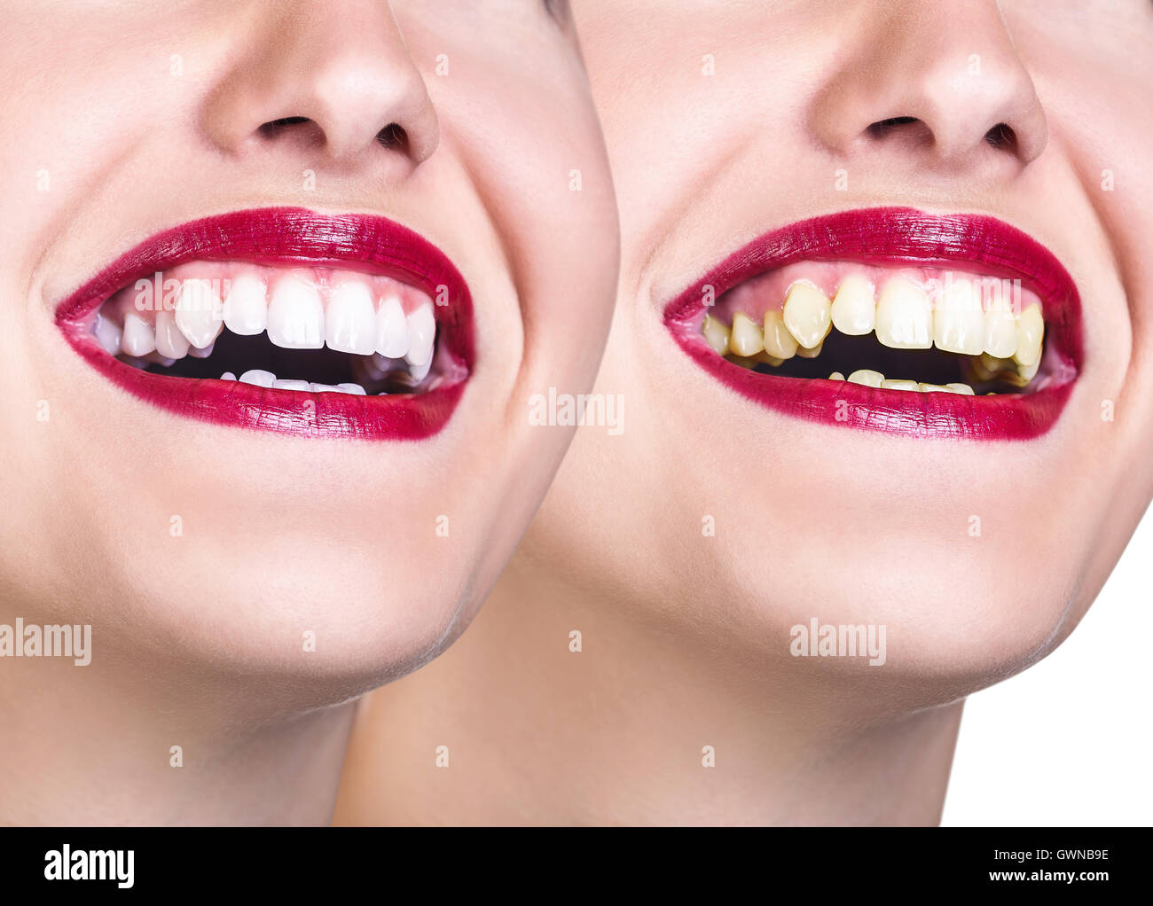 Avant et après le blanchiment des dents. Banque D'Images