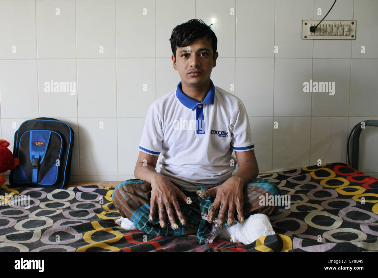 Dhaka, Bangladesh. 18 Sep, 2016. Bajandar Abul, 26 ans, s'assied sur un hôpital bad à Dhaka, Bangladesh, le 18 septembre 2016. Les médecins ont réalisé plusieurs opérations pour enlever les verrues épidermodysplasie verruciforme extrêmement rare de ses mains et ses jambes. Abul, qui a été admis à l'DMCH le 30 janvier, a été atteint d'une maladie de peau génétique extrêmement rare épidermodysplasie verruciforme, qui est aussi appelé 'arbre homme maladie.'' La maladie est causée par un défaut dans le système immunitaire. Elle provoque des anomalies de la sensibilité à l'Human Papilloma Virus (HPV), qui se traduit à la t Banque D'Images