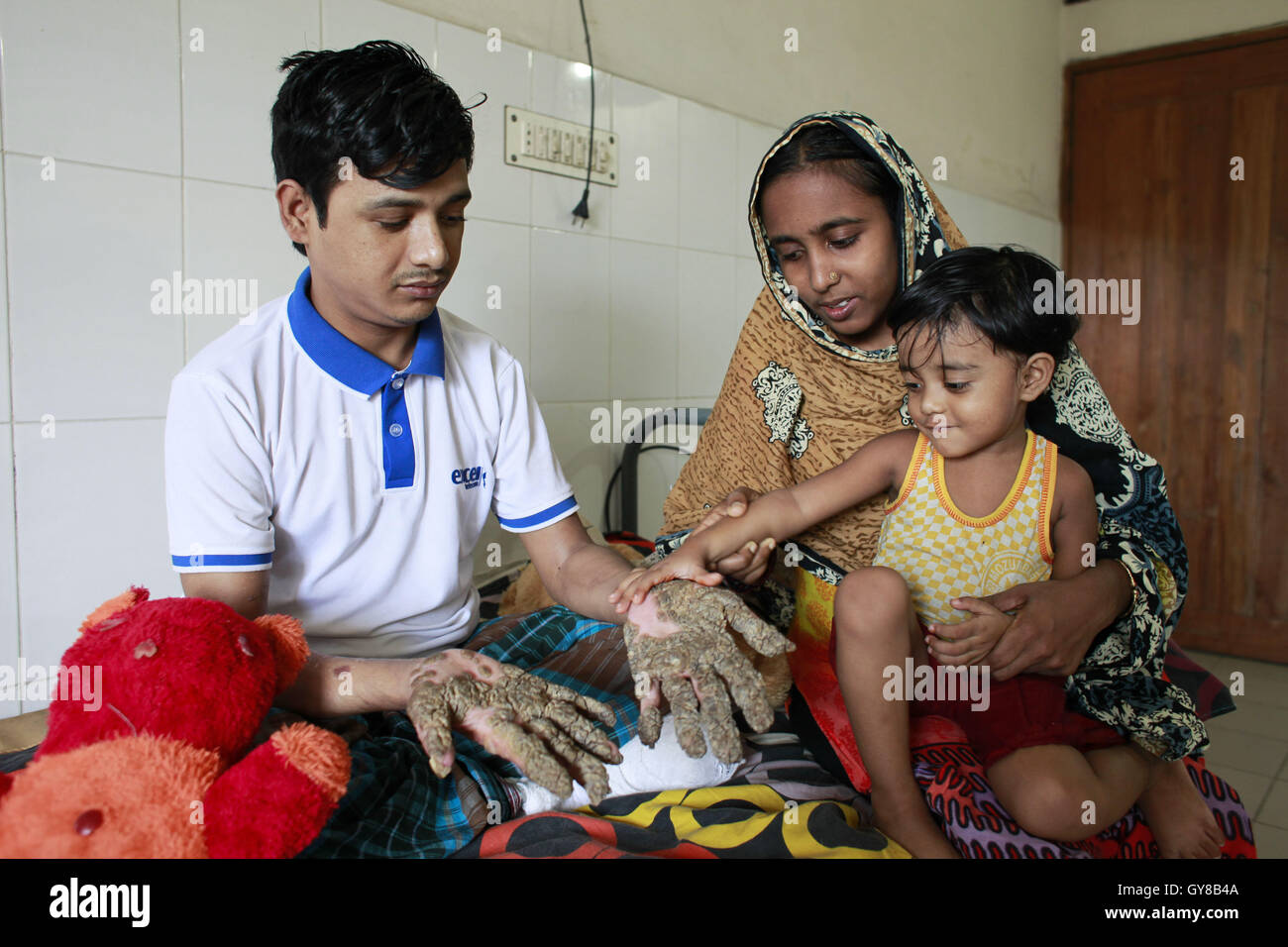 Dhaka, Bangladesh. 18 Sep, 2016. Tahera, 3, fille d'Abul Bajandar, touche la main de son père dans un hôpital bad à Dhaka, Bangladesh, le 18 septembre 2016. Les médecins ont réalisé plusieurs opérations pour enlever les verrues épidermodysplasie verruciforme extrêmement rare de ses mains et ses jambes. Abul, qui a été admis à l'DMCH le 30 janvier, a été atteint d'une maladie de peau génétique extrêmement rare épidermodysplasie verruciforme, qui est aussi appelé 'arbre homme maladie.'' La maladie est causée par un défaut dans le système immunitaire. Elle provoque des anomalies de la sensibilité à l'Human Papilloma Banque D'Images