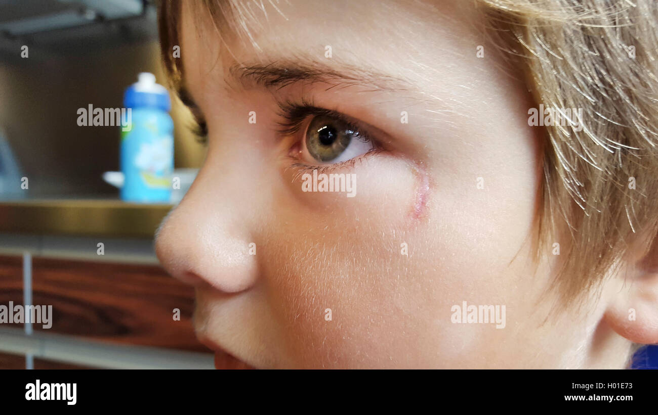 Petit garçon avec une cicatrice de lacération guéri à l'oeil, portrait, Allemagne Banque D'Images