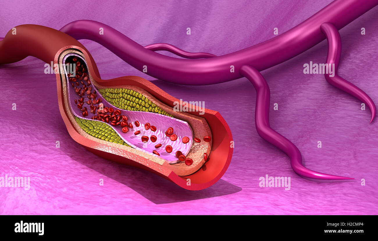 Plaque de cholestérol dans le sang , navire précis médicalement 3D illustration Banque D'Images