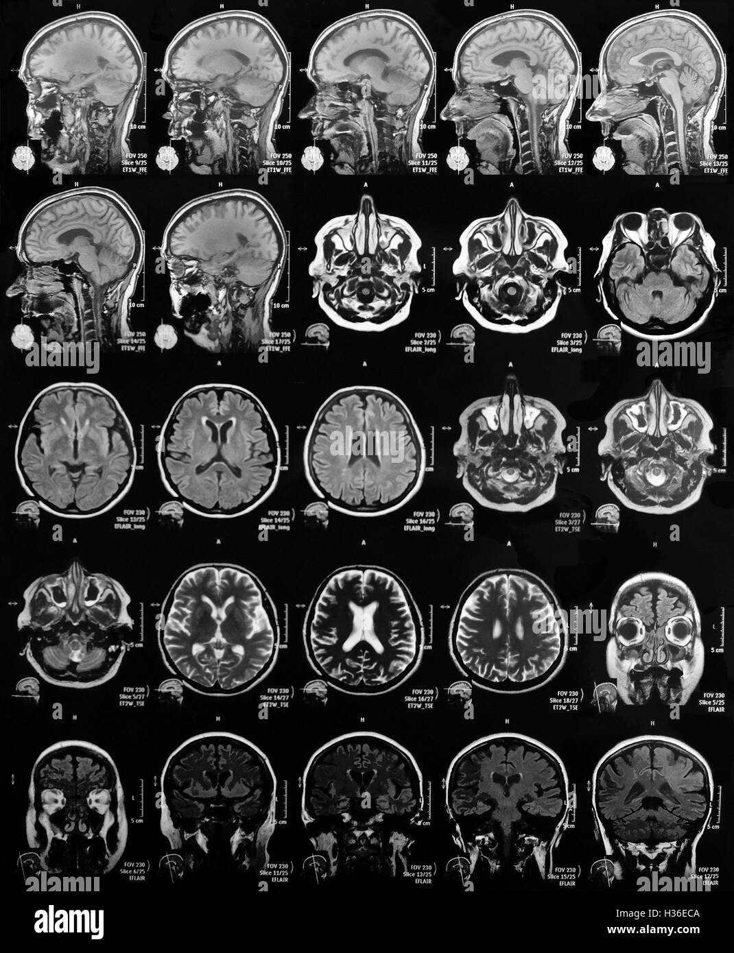L'imagerie par résonance magnétique du cerveau Banque D'Images