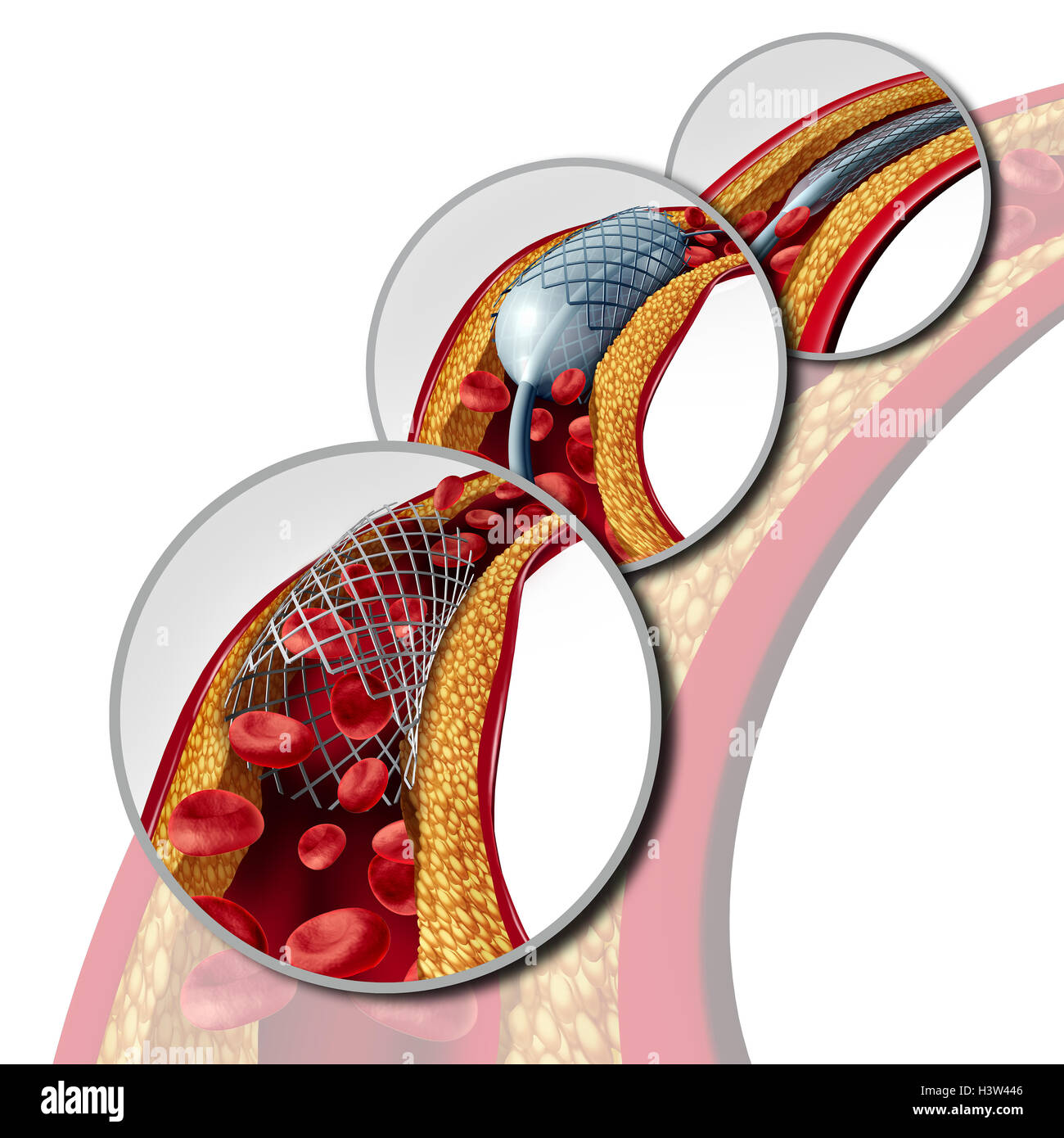 Angioplastie et stent concept comme une maladie du cœur symbole traitement diagramme avec les étapes d'une procédure d'implantation dans une artère qui a un blocage de la plaque de cholestérol étant ouverte à l'augmentation du débit sanguin en tant que 3D illustration. Banque D'Images