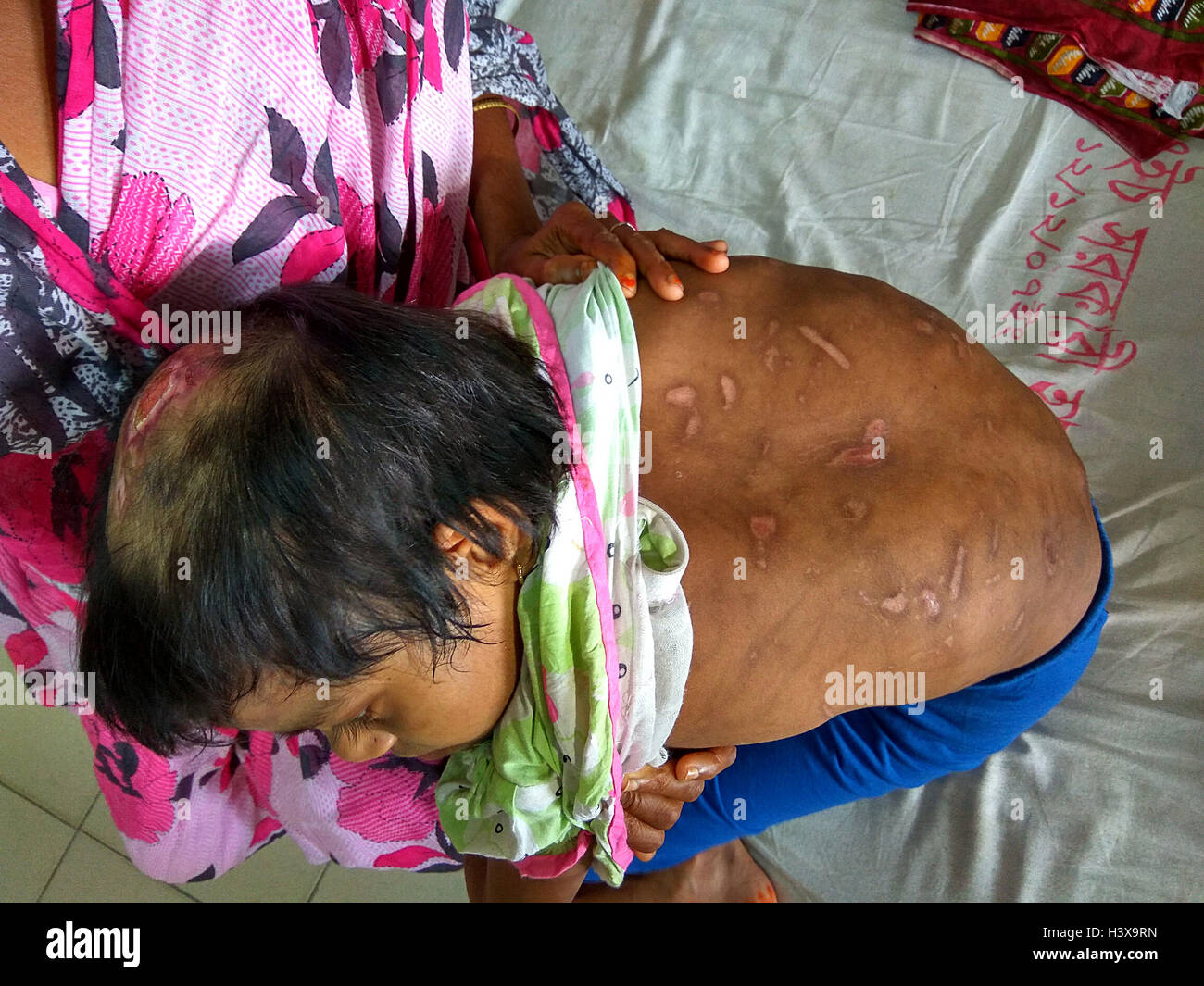 Dhaka 02 octobre 2016. Une femme montrant les cicatrices sur le corps de sa fille de 7 ans, à l'Jannat dirigé de de Dhaka Medical College Hospital récemment. Jannat, qui a travaillé en tant qu'enfant servante à Gazipur, près de la capitale du Bangladesh, était souvent battu son employeur, une femme au foyer. La dame a également utilisé pour brûler plusieurs parties du corps de la jeune fille avec un fer chaud et les ustensiles. Banque D'Images