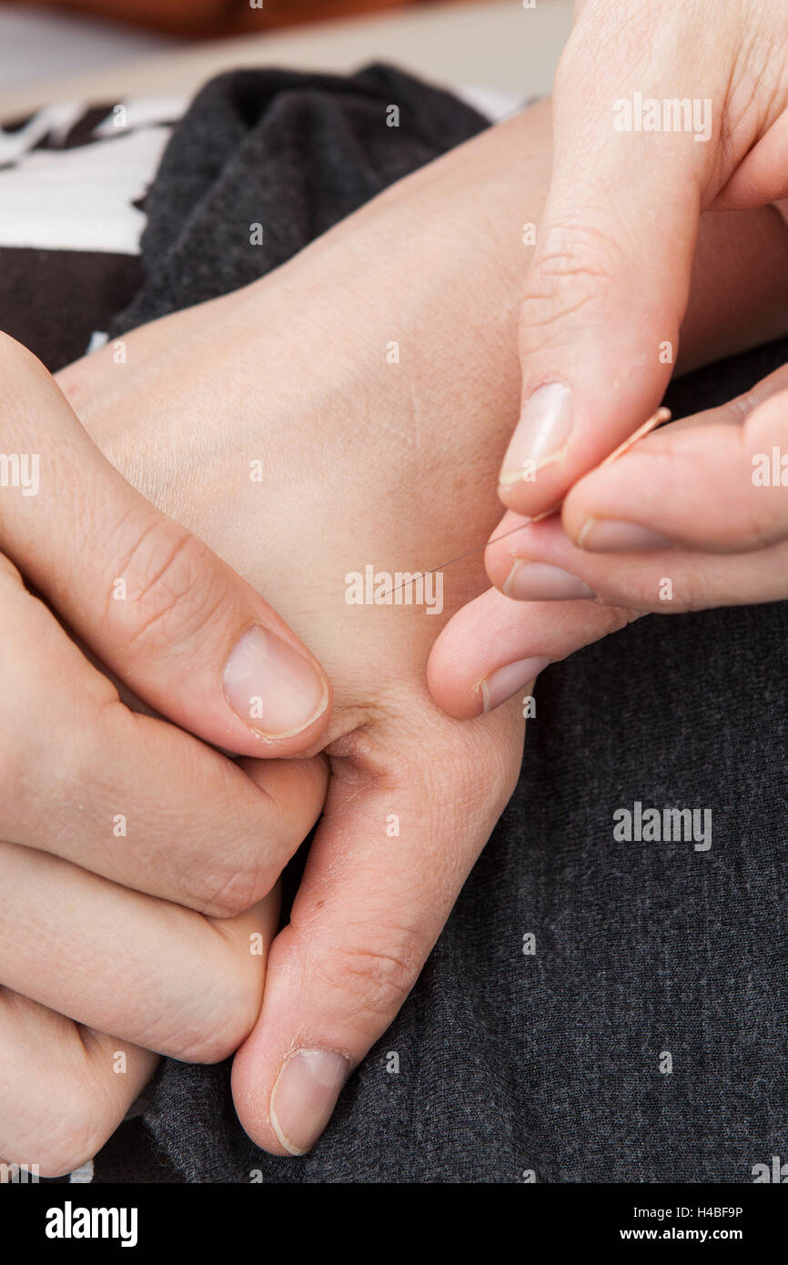 L'acupuncture, la main, l'aiguille, aiguille d'acupuncture, Banque D'Images