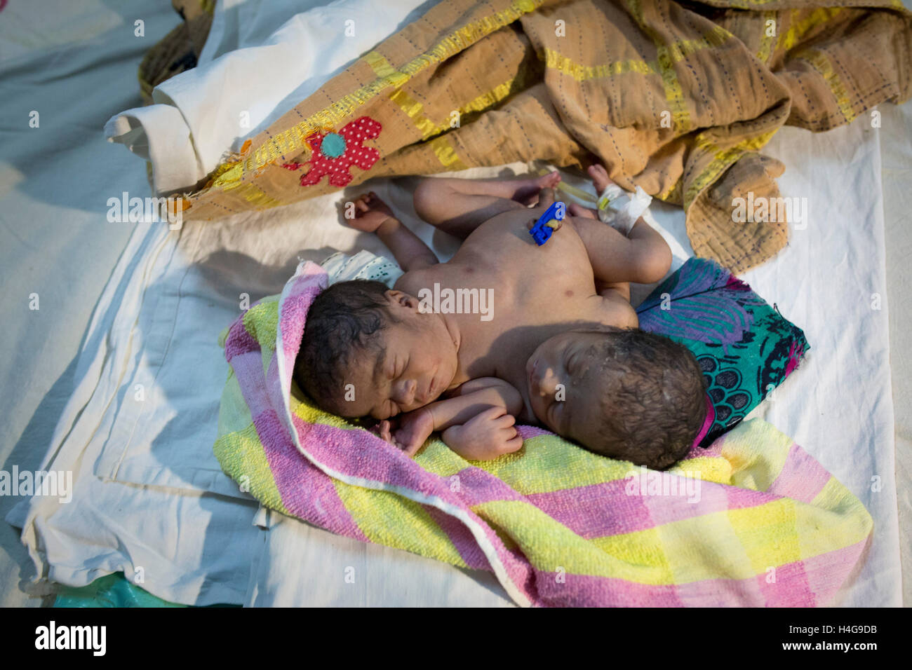Dhaka, Bangladesh. 15 octobre, 2016. Les parents auraient abandonné les jumeaux siamois au Dhaka Medical College Hospital à Dhaka, Bangladesh, le 15 octobre 2016. DMCH (Dhaka Medical College Hospital) Directeur adjoint Khaja Abdul Gafursaid, 'Les enfants, avec deux têtes, quatre mains et deux jambes, sont nés dans une clinique inconnue à Dhaka et ont été prises pour l'DMCH vendredi soir. Plus tard, leurs parents ont fui en laissant les jumeaux à l'enfant ward." Crédit : zakir Hossain Chowdhury zakir/Alamy Live News Banque D'Images