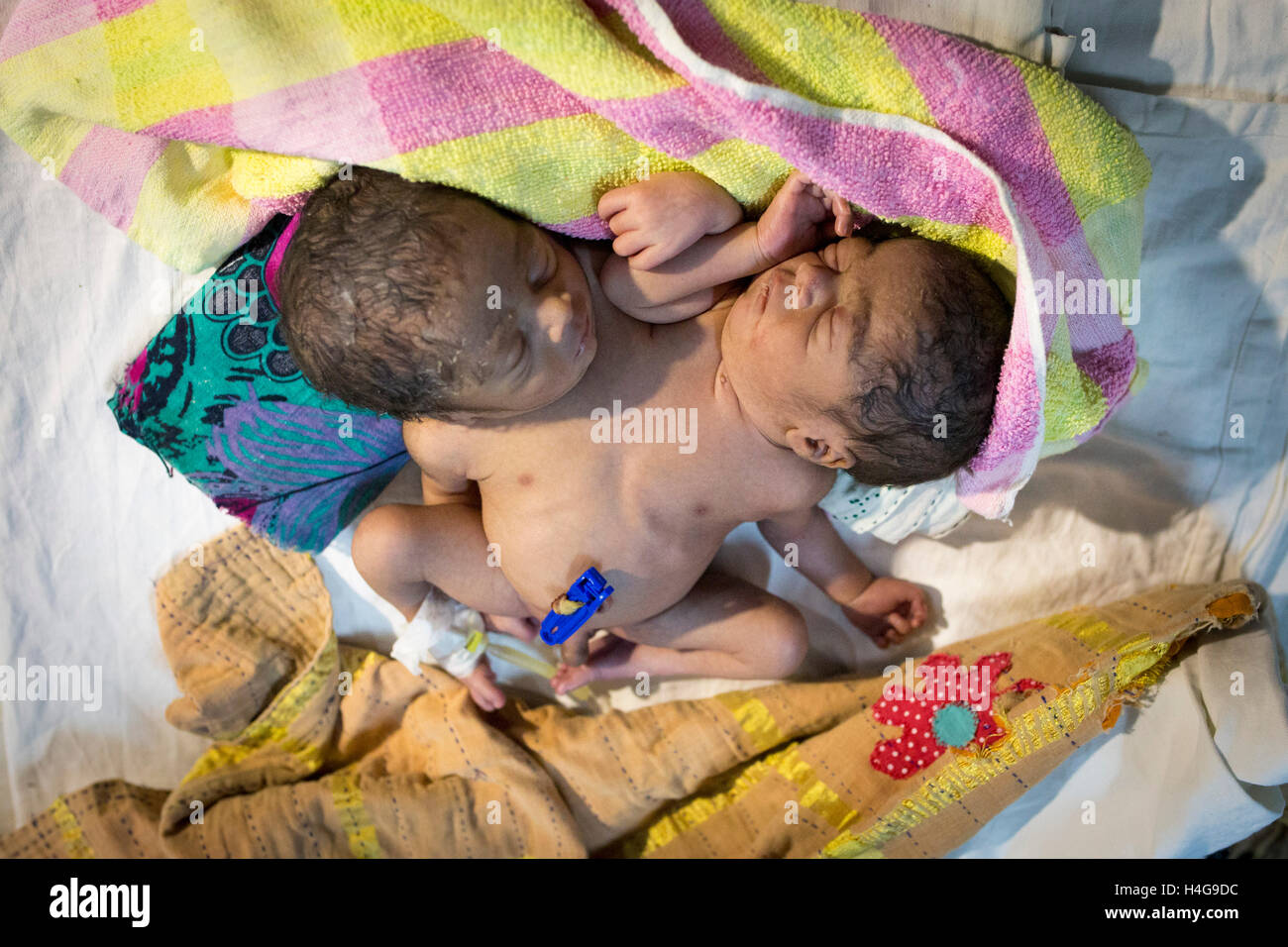 Dhaka, Bangladesh. 15 octobre, 2016. Les parents auraient abandonné les jumeaux siamois au Dhaka Medical College Hospital à Dhaka, Bangladesh, le 15 octobre 2016. DMCH (Dhaka Medical College Hospital) Directeur adjoint Khaja Abdul Gafursaid, 'Les enfants, avec deux têtes, quatre mains et deux jambes, sont nés dans une clinique inconnue à Dhaka et ont été prises pour l'DMCH vendredi soir. Plus tard, leurs parents ont fui en laissant les jumeaux à l'enfant ward." Crédit : zakir Hossain Chowdhury zakir/Alamy Live News Banque D'Images