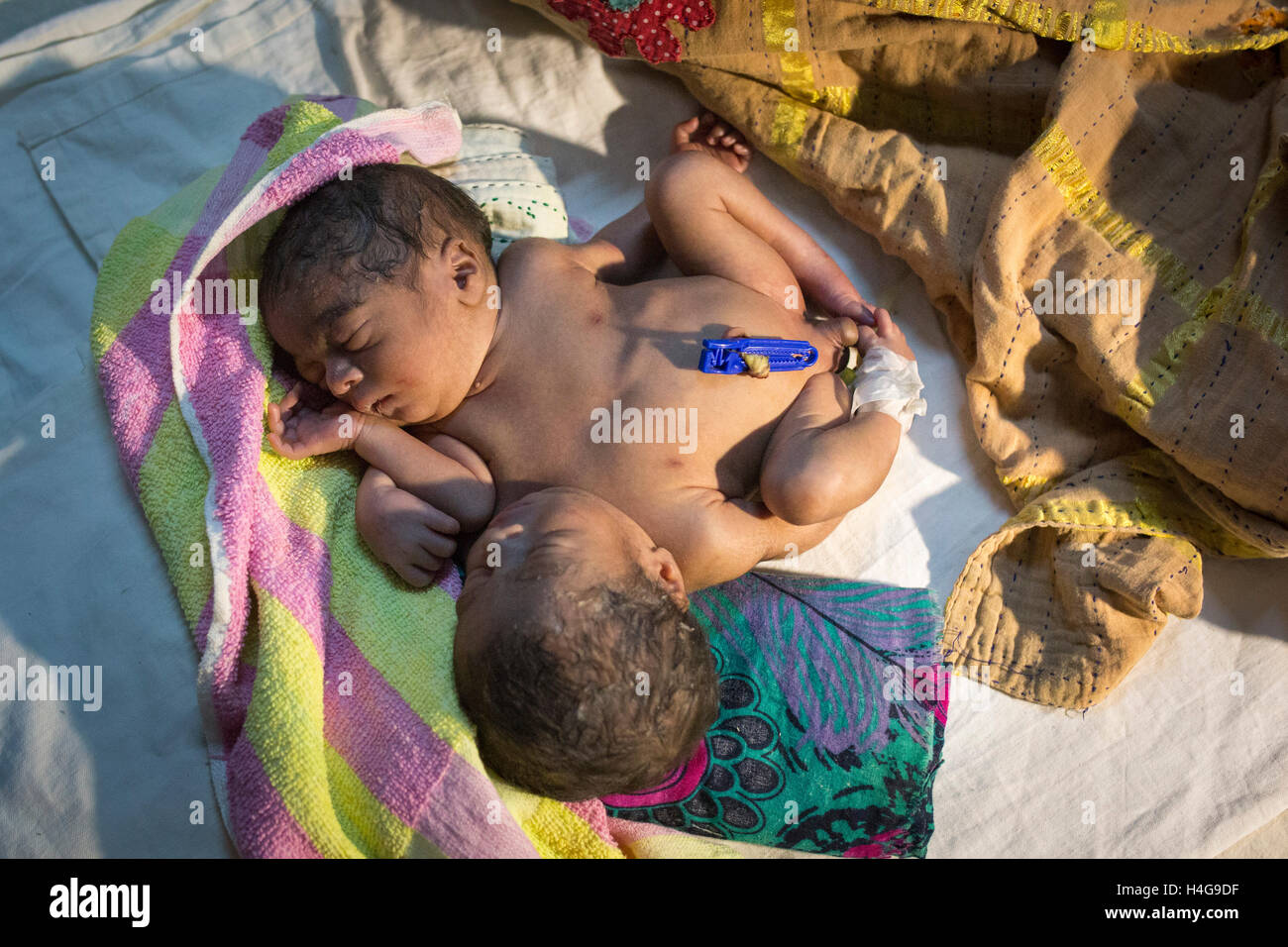 Dhaka, Bangladesh. 15 octobre, 2016. Les parents auraient abandonné les jumeaux siamois au Dhaka Medical College Hospital à Dhaka, Bangladesh, le 15 octobre 2016. DMCH (Dhaka Medical College Hospital) Directeur adjoint Khaja Abdul Gafursaid, 'Les enfants, avec deux têtes, quatre mains et deux jambes, sont nés dans une clinique inconnue à Dhaka et ont été prises pour l'DMCH vendredi soir. Plus tard, leurs parents ont fui en laissant les jumeaux à l'enfant ward." Crédit : zakir Hossain Chowdhury zakir/Alamy Live News Banque D'Images