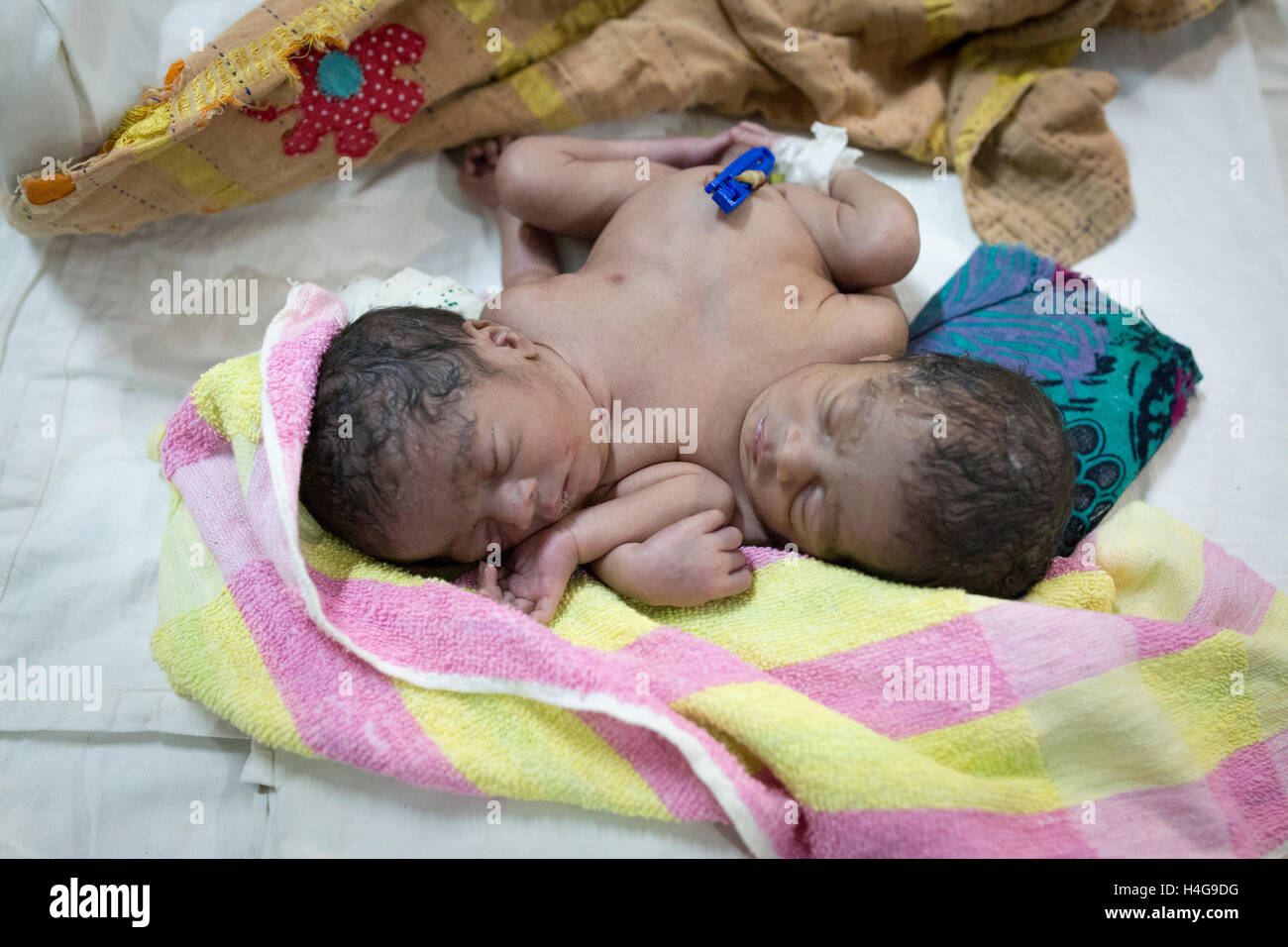Dhaka, Bangladesh. 15 octobre, 2016. Les parents auraient abandonné les jumeaux siamois au Dhaka Medical College Hospital à Dhaka, Bangladesh, le 15 octobre 2016. DMCH (Dhaka Medical College Hospital) Directeur adjoint Khaja Abdul Gafursaid, 'Les enfants, avec deux têtes, quatre mains et deux jambes, sont nés dans une clinique inconnue à Dhaka et ont été prises pour l'DMCH vendredi soir. Plus tard, leurs parents ont fui en laissant les jumeaux à l'enfant ward." Crédit : zakir Hossain Chowdhury zakir/Alamy Live News Banque D'Images