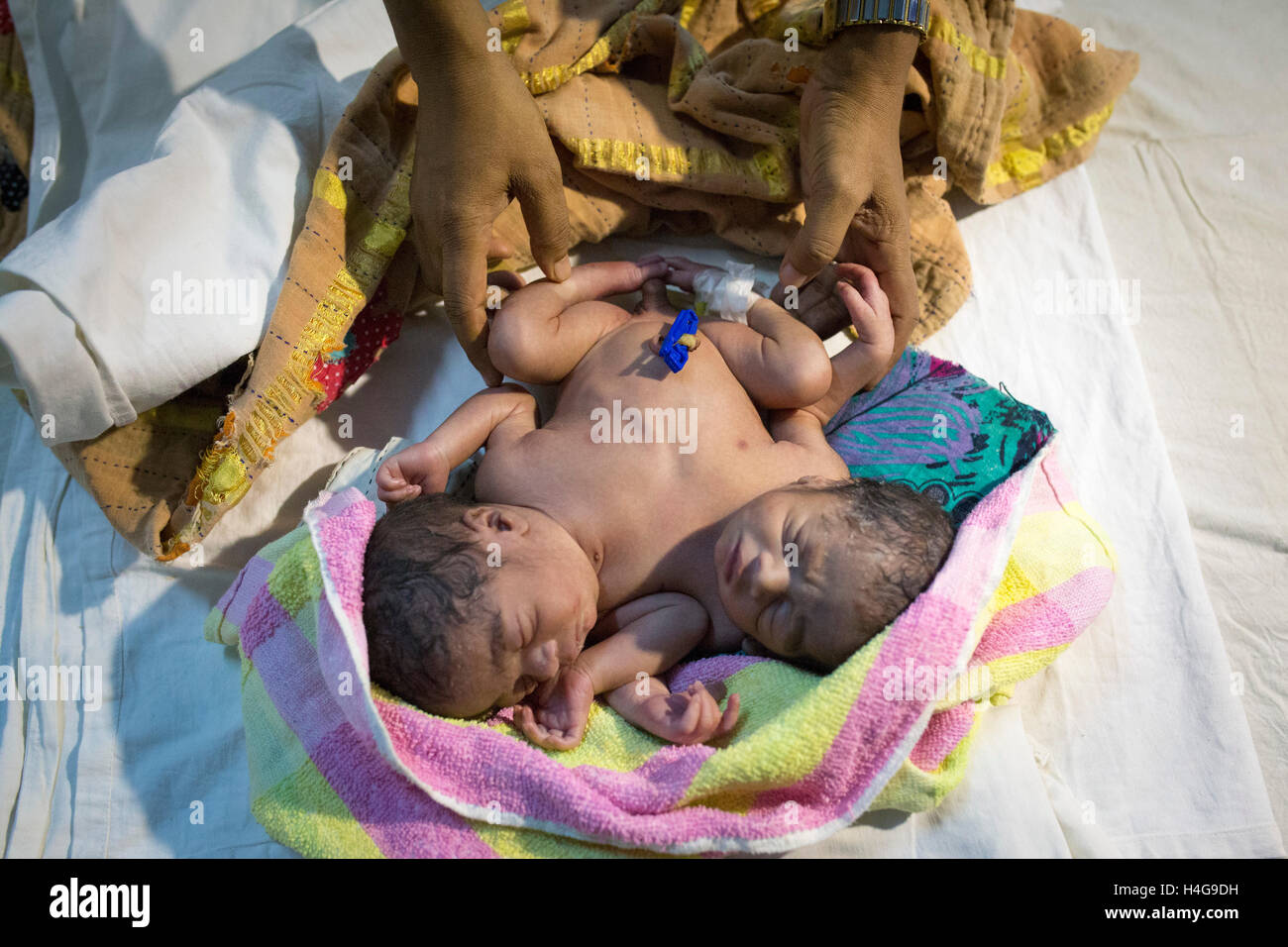 Dhaka, Bangladesh. 15 octobre, 2016. Les parents auraient abandonné les jumeaux siamois au Dhaka Medical College Hospital à Dhaka, Bangladesh, le 15 octobre 2016. DMCH (Dhaka Medical College Hospital) Directeur adjoint Khaja Abdul Gafursaid, 'Les enfants, avec deux têtes, quatre mains et deux jambes, sont nés dans une clinique inconnue à Dhaka et ont été prises pour l'DMCH vendredi soir. Plus tard, leurs parents ont fui en laissant les jumeaux à l'enfant ward." Crédit : zakir Hossain Chowdhury zakir/Alamy Live News Banque D'Images