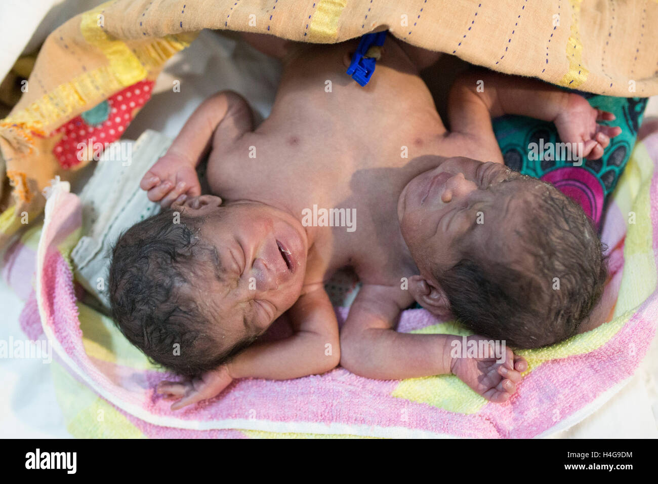 Dhaka, Bangladesh. 15 octobre, 2016. Les parents auraient abandonné les jumeaux siamois au Dhaka Medical College Hospital à Dhaka, Bangladesh, le 15 octobre 2016. DMCH (Dhaka Medical College Hospital) Directeur adjoint Khaja Abdul Gafursaid, 'Les enfants, avec deux têtes, quatre mains et deux jambes, sont nés dans une clinique inconnue à Dhaka et ont été prises pour l'DMCH vendredi soir. Plus tard, leurs parents ont fui en laissant les jumeaux à l'enfant ward." Crédit : zakir Hossain Chowdhury zakir/Alamy Live News Banque D'Images