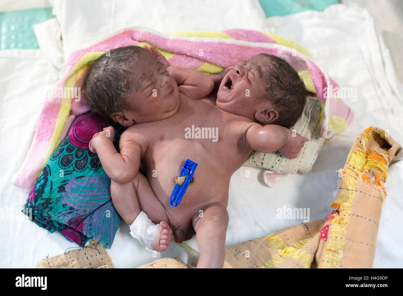 Dhaka, Bangladesh. 15 octobre, 2016. Les parents auraient abandonné les jumeaux siamois au Dhaka Medical College Hospital à Dhaka, Bangladesh, le 15 octobre 2016. DMCH (Dhaka Medical College Hospital) Directeur adjoint Khaja Abdul Gafursaid, 'Les enfants, avec deux têtes, quatre mains et deux jambes, sont nés dans une clinique inconnue à Dhaka et ont été prises pour l'DMCH vendredi soir. Plus tard, leurs parents ont fui en laissant les jumeaux à l'enfant ward." Crédit : zakir Hossain Chowdhury zakir/Alamy Live News Banque D'Images