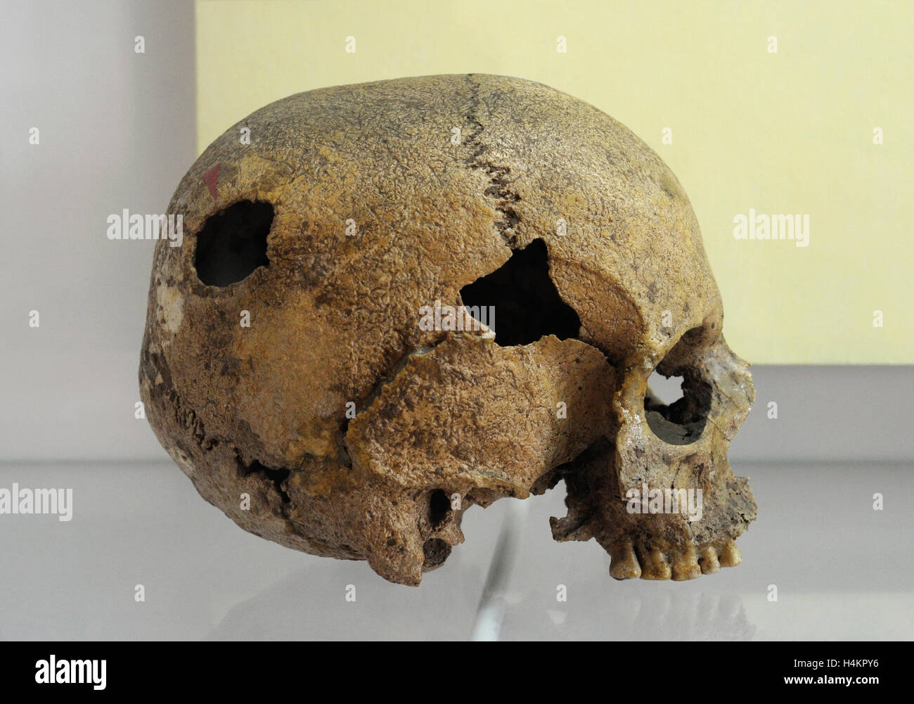 La Pologne. La préhistoire. Crâne humain marqué avec post-trephination trou. Elle est présentée dans une exposition permanente "maladie de la population préhistorique en terre polonaise". Musée archéologique. Gdansk. La Pologne. Banque D'Images