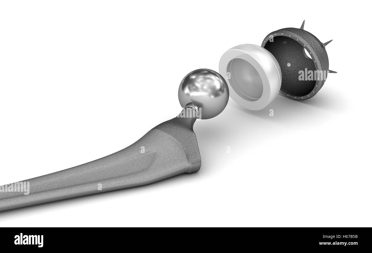 L'implant de remplacement de la hanche isolé sur blanc. Illustration 3D précis médicalement Banque D'Images