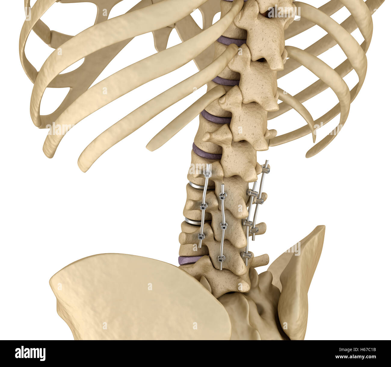 Système de fixation de la colonne vertébrale - titane support. Dent précise médicalement 3D illustration Banque D'Images