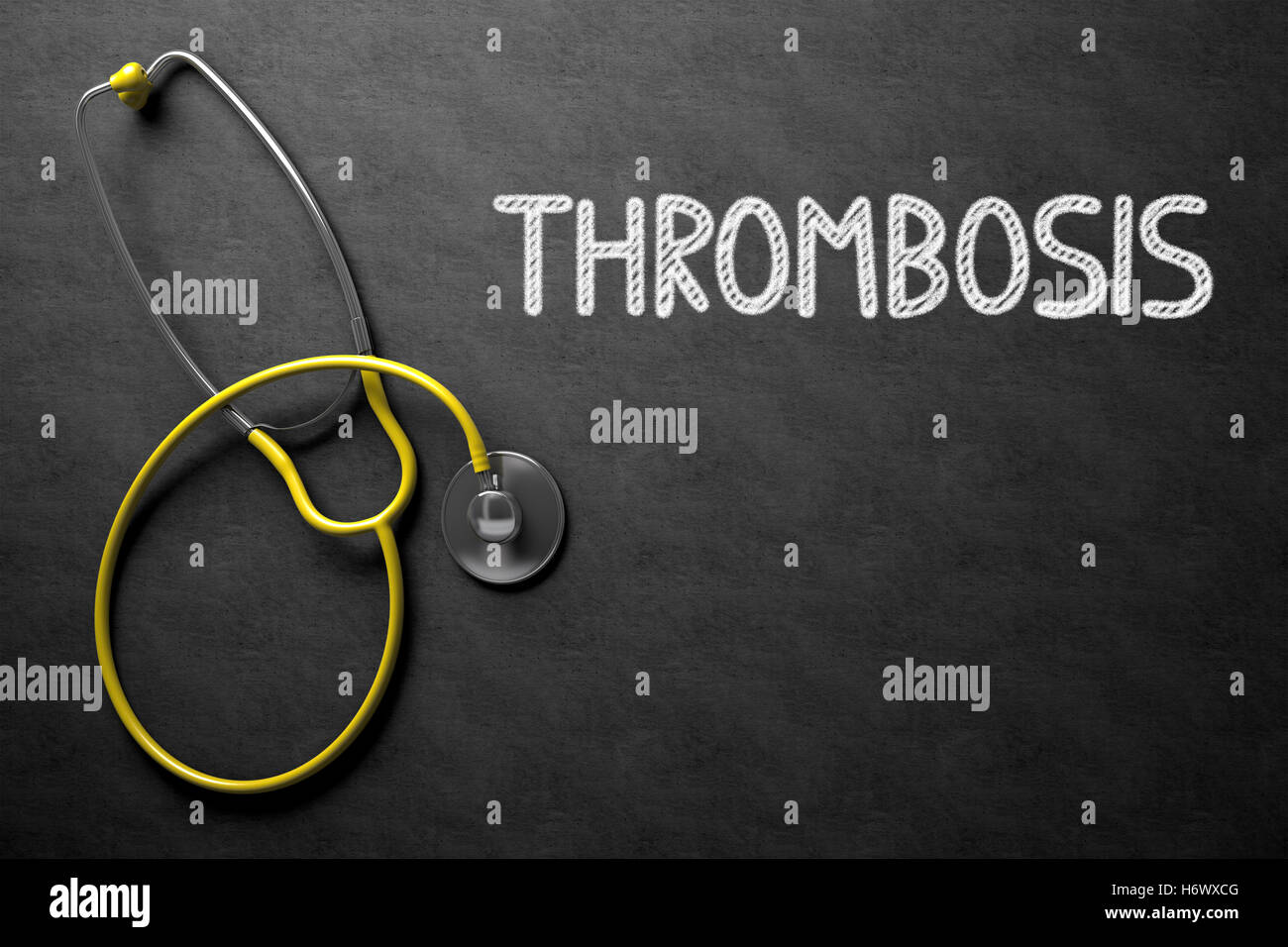 Concept de thrombose sur tableau. 3D Illustration. Banque D'Images