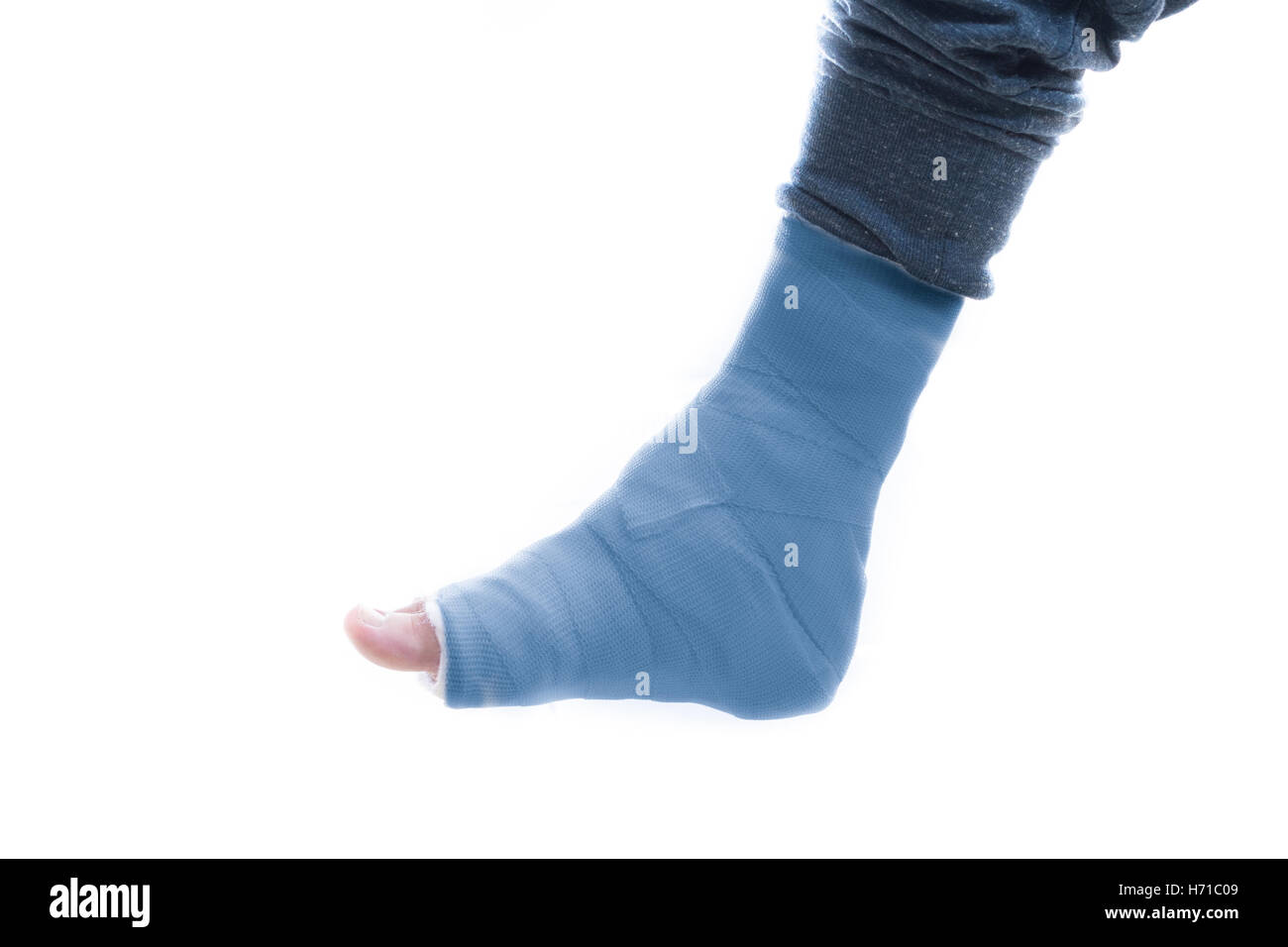 Fibre de verre bleu et la jambe de plâtre cast portés par un jeune homme (isolé sur blanc) Banque D'Images