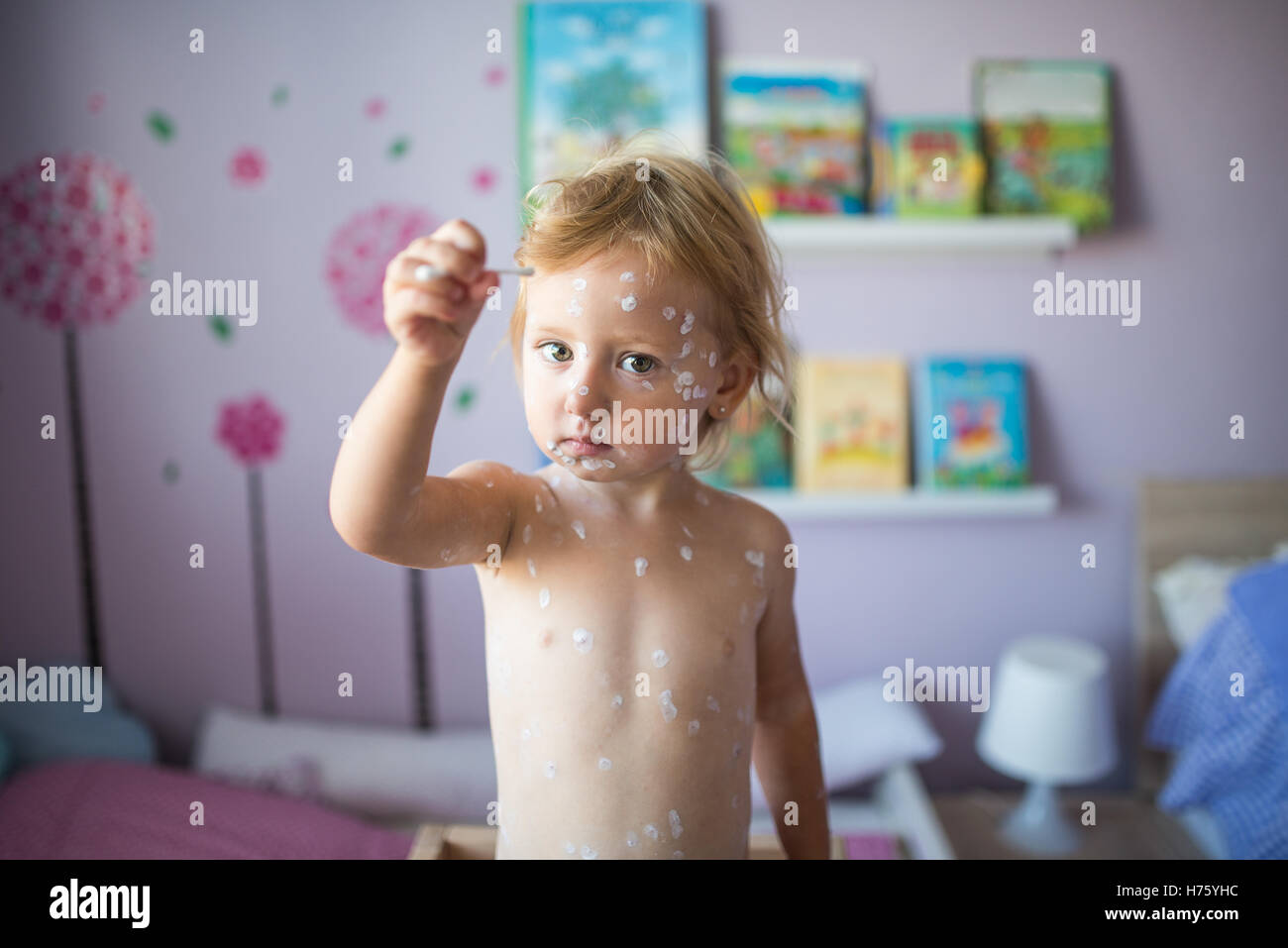 Petite fille avec la varicelle, crème antiseptique appliqué à rash Banque D'Images