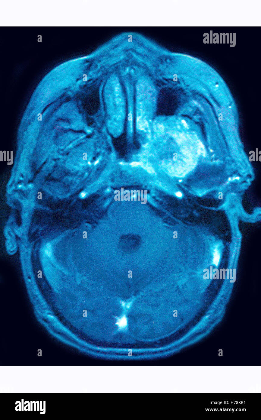 NEURINOME IRM Banque D'Images